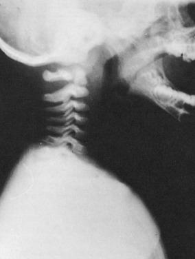 Fig. 140.1, Detection of cervical spine injuries or abnormalities in the young child can be challenging, because much of the cervical spine has not yet ossified. The anterior ring of C1 does not ossify until after the age of 1 year and is not visible on plain radiographs at that age, as depicted here.