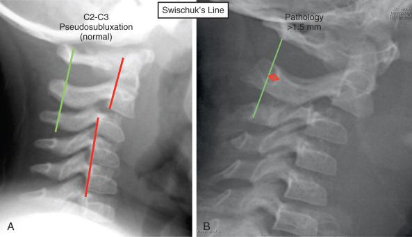 Fig. 140.2, Pseudo-subluxation can be differentiated from true subluxation on plain radiographs by the maintenance of the Swischuk line (green) , which is a straight line drawn along the anterior edge of the posterior neural arch. (A) The patient has no acute injury, which is confirmed by the maintenance of this line. (B) The patient has a change in the relation of the posterior elements to this line, which represents true subluxation.