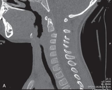 Fig. 140.3, (A and B) Although pseudosubluxation is a normal finding that does not require treatment, true injuries can also occur at this level. Sagittal and 3D computed tomography scan images of a 3-year-old involved in a high-speed motor vehicle collision demonstrate jumped facets at C2-C3. Magnetic resonance imaging confirmed extensive associated ligamentous injury.