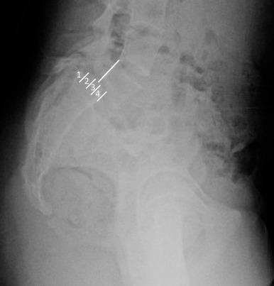 Fig. 140.4, An example of grade 3 spondylolisthesis using the Meyerding grading system. This system describes the percentage of translation of the superior vertebral body relative to the inferior vertebral body. Grade 1 = 1% to 24%; grade 2 = 25% to 49%; grade 3 = 50% to 74%; and grade 4 = 75% to 100%. Cases in which the amount of displacement exceeds 100% are referred to as spondyloptosis.