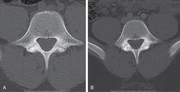 Fig. 140.6, (A) The presence of a bilateral pars defect on a noncontrast computed tomography (CT) scan consistent with a diagnosis of acute spondylolysis. (B) A subsequent CT scan with contrast-confirmed healing of the defect after successful conservative treatment.