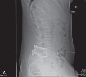 Fig. 140.8, (A and B) This 17-year-old female with an L5 spondylolysis was in severe pain despite months of conservative management. Following a successful anterior and posterior spinal fusion of L5-S1, she returned to competitive dance. Clinical photos demonstrate that she maintained excellent flexibility and range of motion following this one-level fusion.