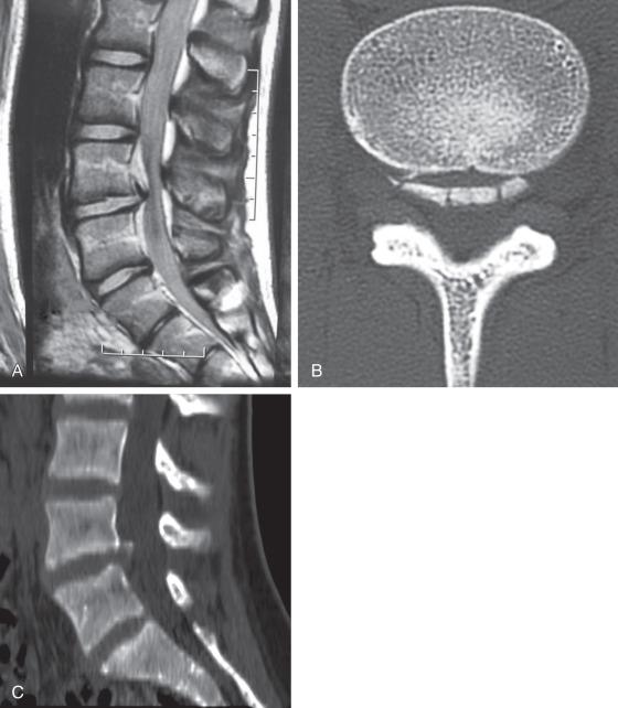 Fig. 140.9, Magnetic resonance imaging (A) gives the appearance of a disk herniation, but a computed tomography scan (B and C) clearly shows that it is in fact an apophyseal ring fracture.