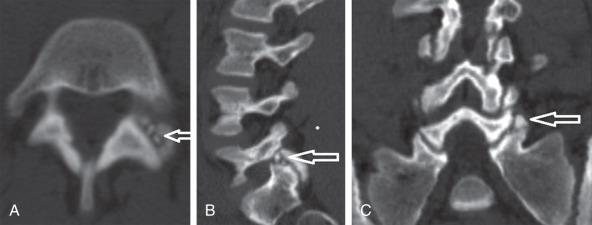 Fig. 140.10, Magnetic resonance imaging scan (A) and A computed tomography scans (B and C) depicting a sacral facet fracture (arrows) .