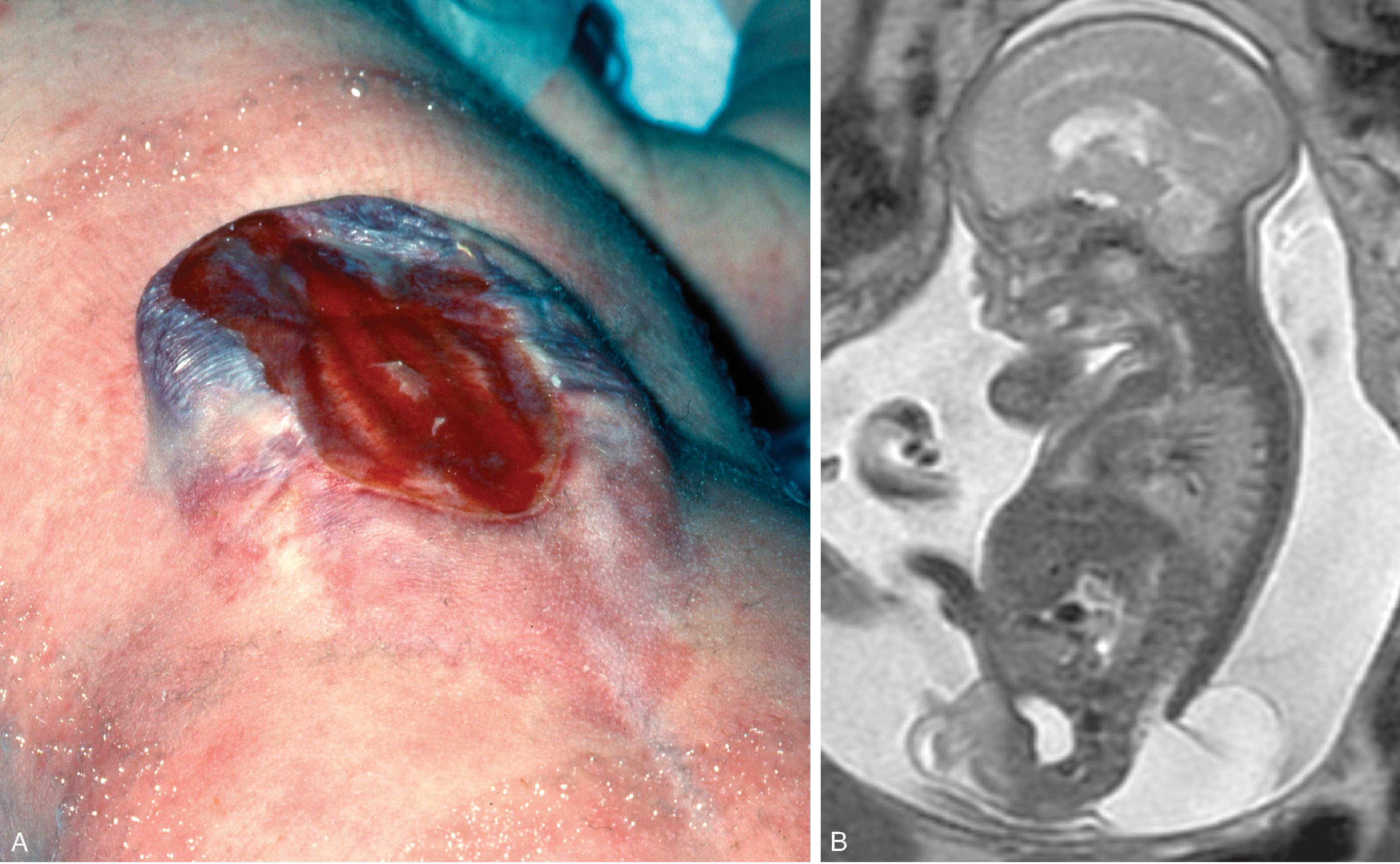 Fig. 16.3, Myelomeningocele.