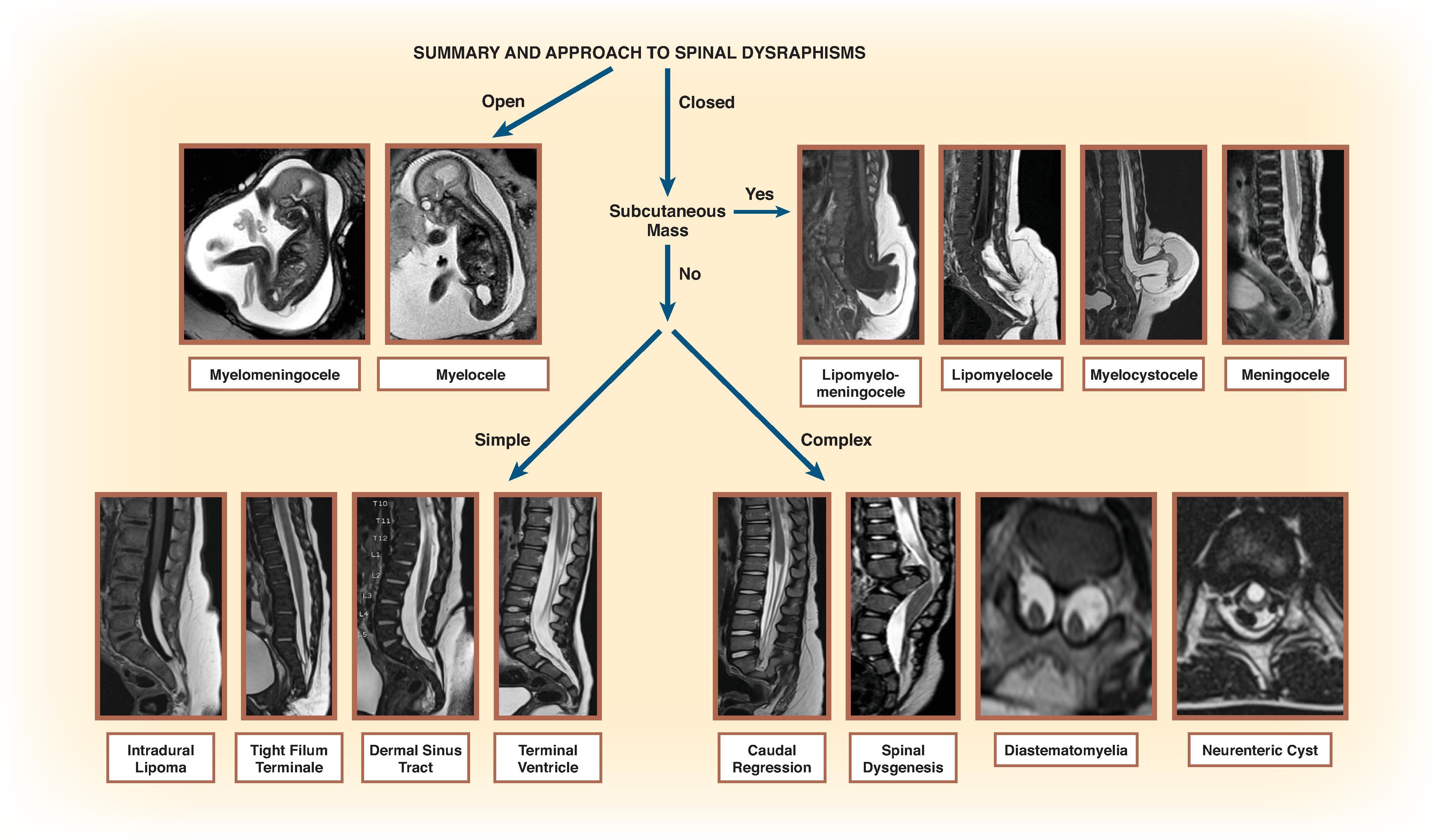 Fig. 16.2, Imaging Approach to Spinal Dysraphisms.