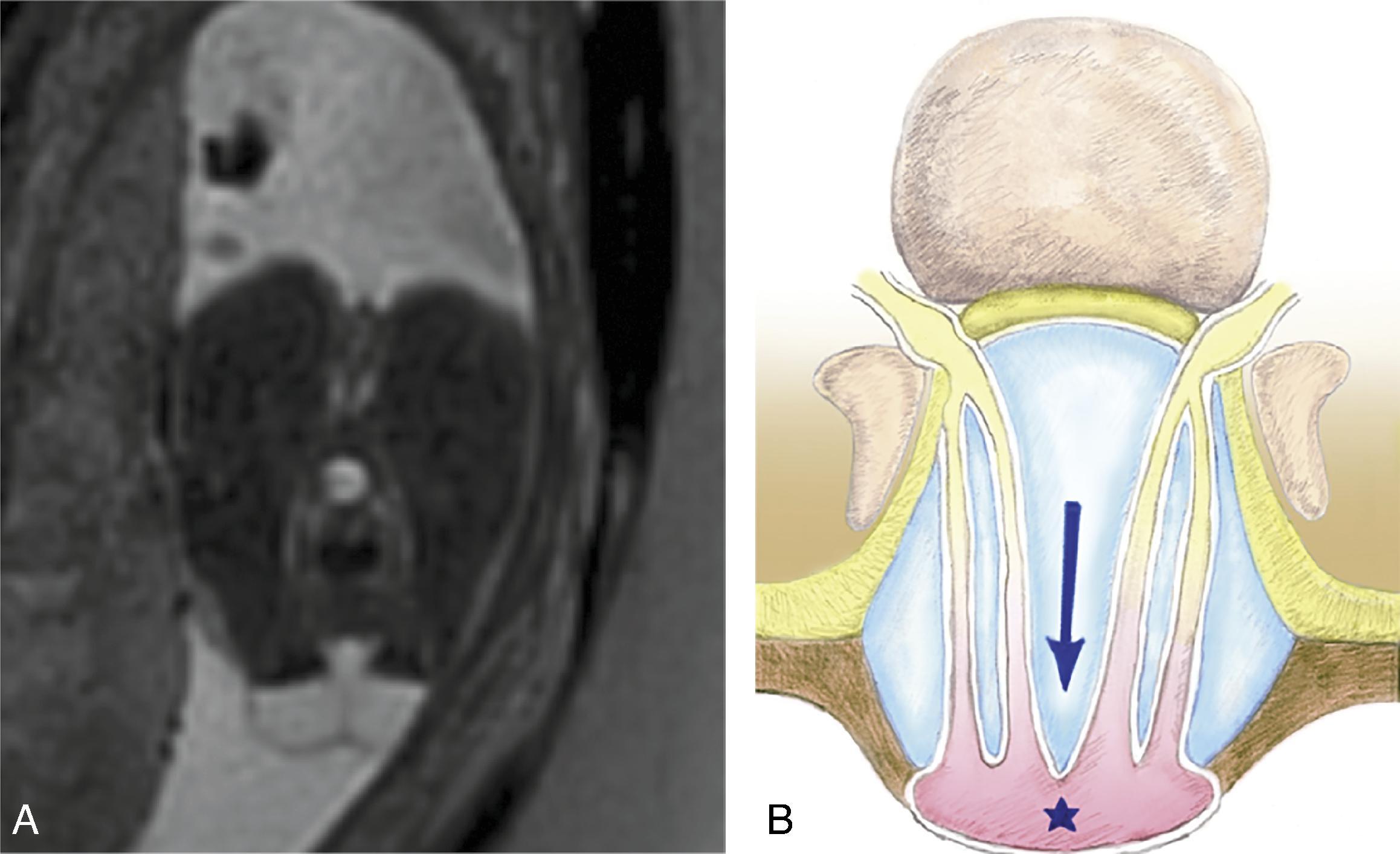 Fig. 16.5, Myelomeningocele.