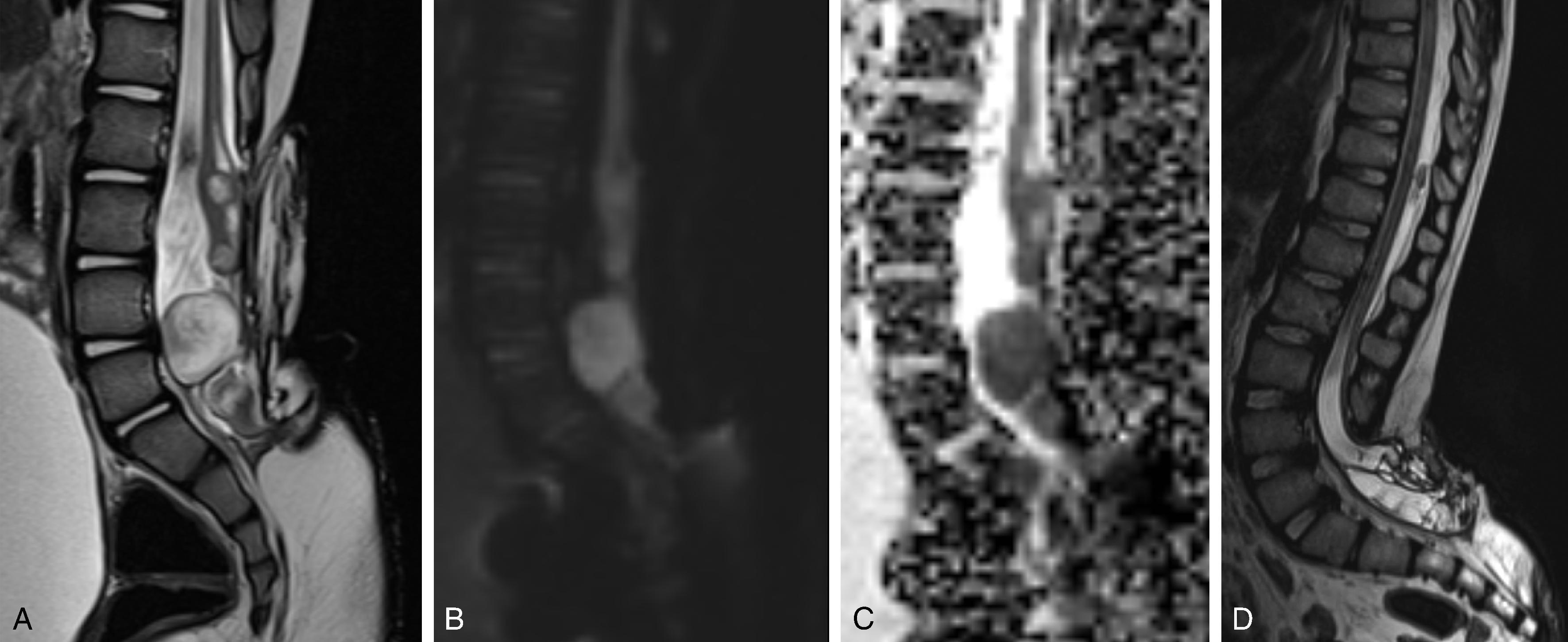 Fig. 16.6, Myelomeningocele: Post-surgical Findings.