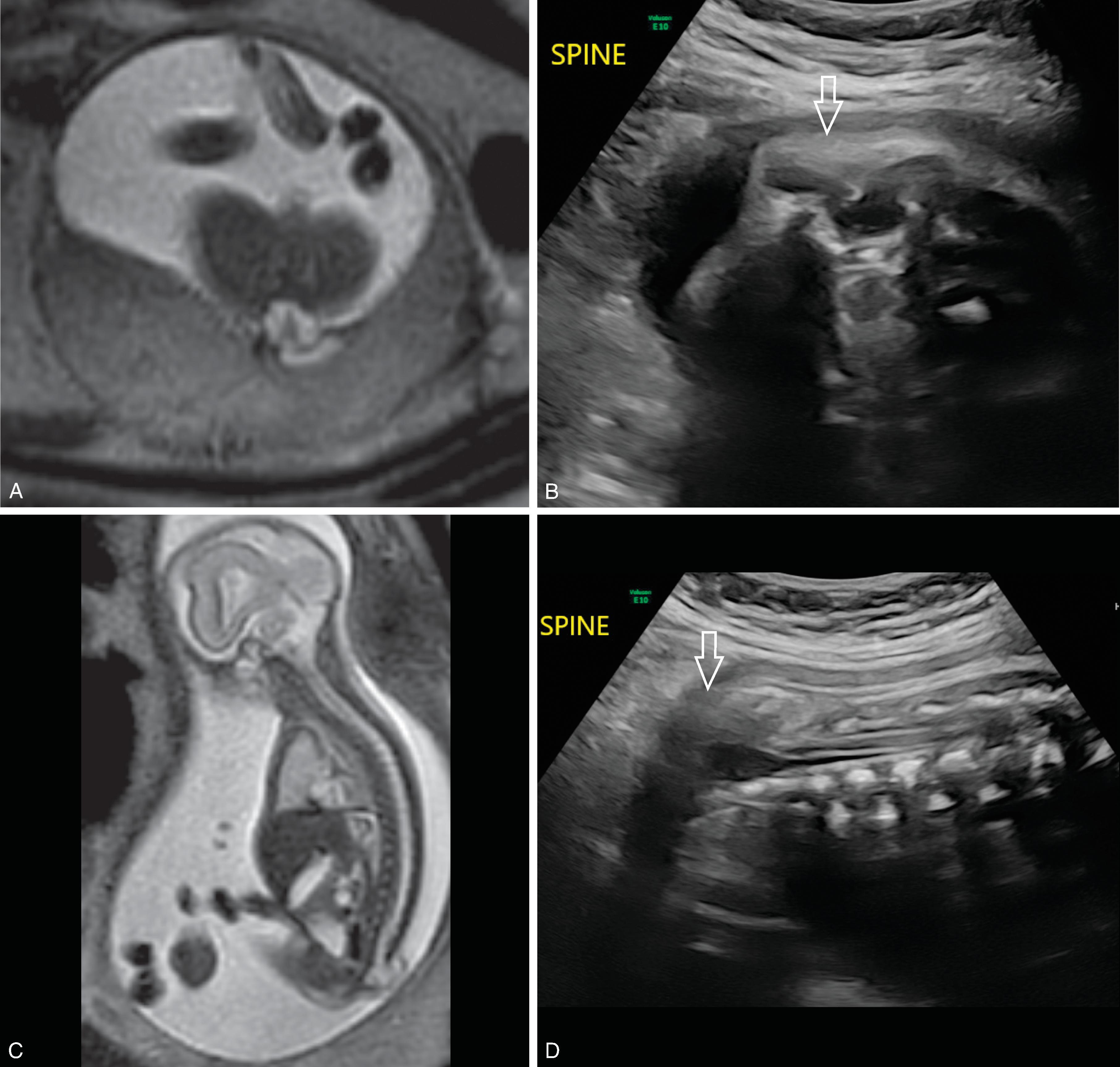 Fig. 16.9, Lipomyelomeningocele.