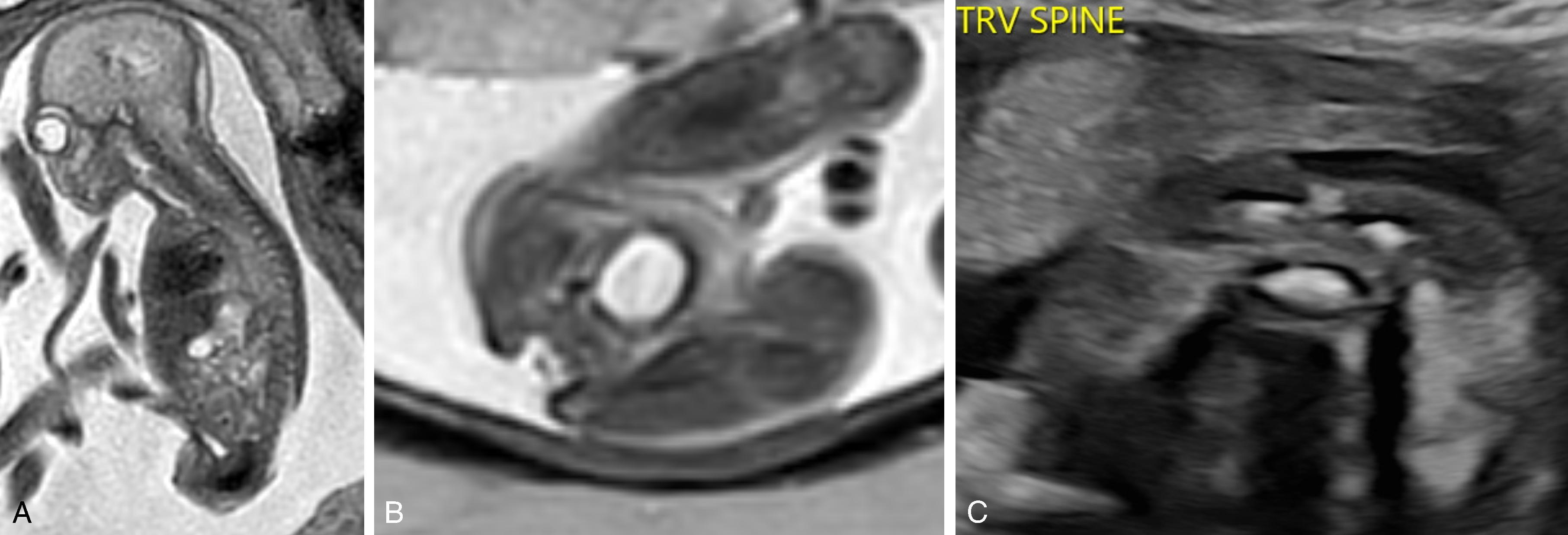 Fig. 16.7, Myelocele.