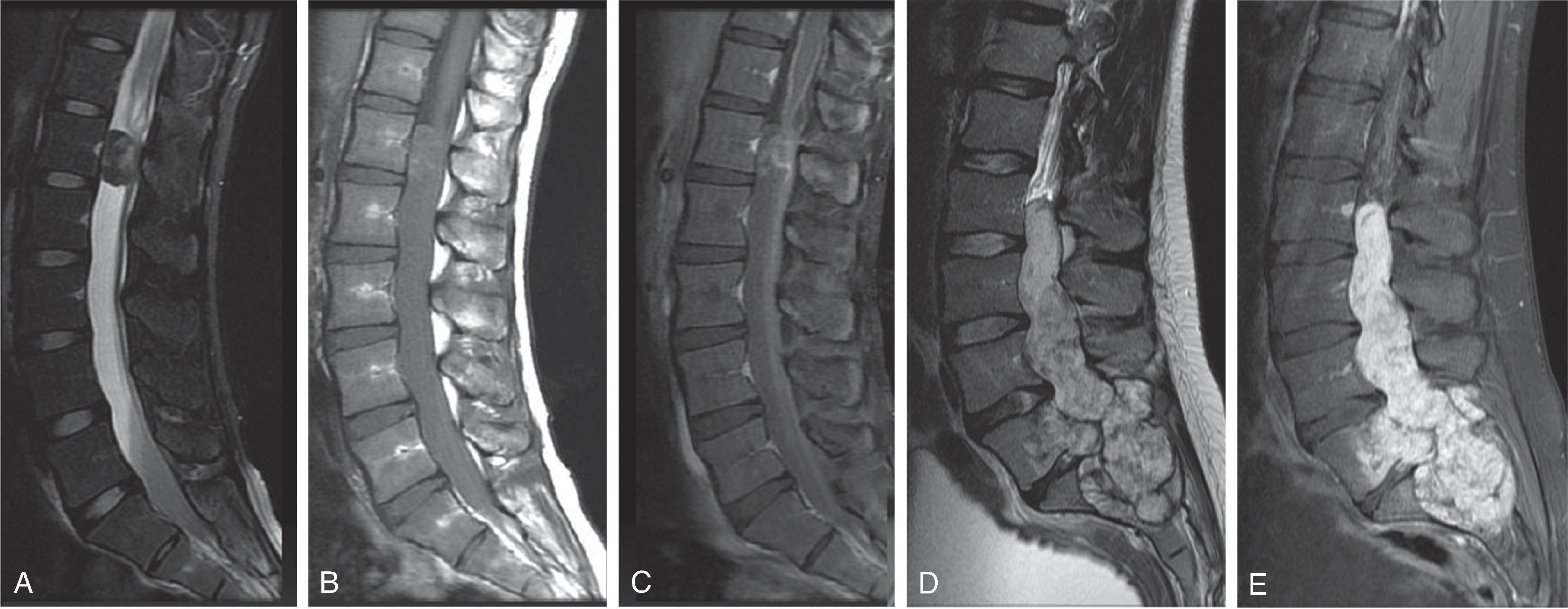 Fig. 17.9, Myxopapillary Ependymoma.