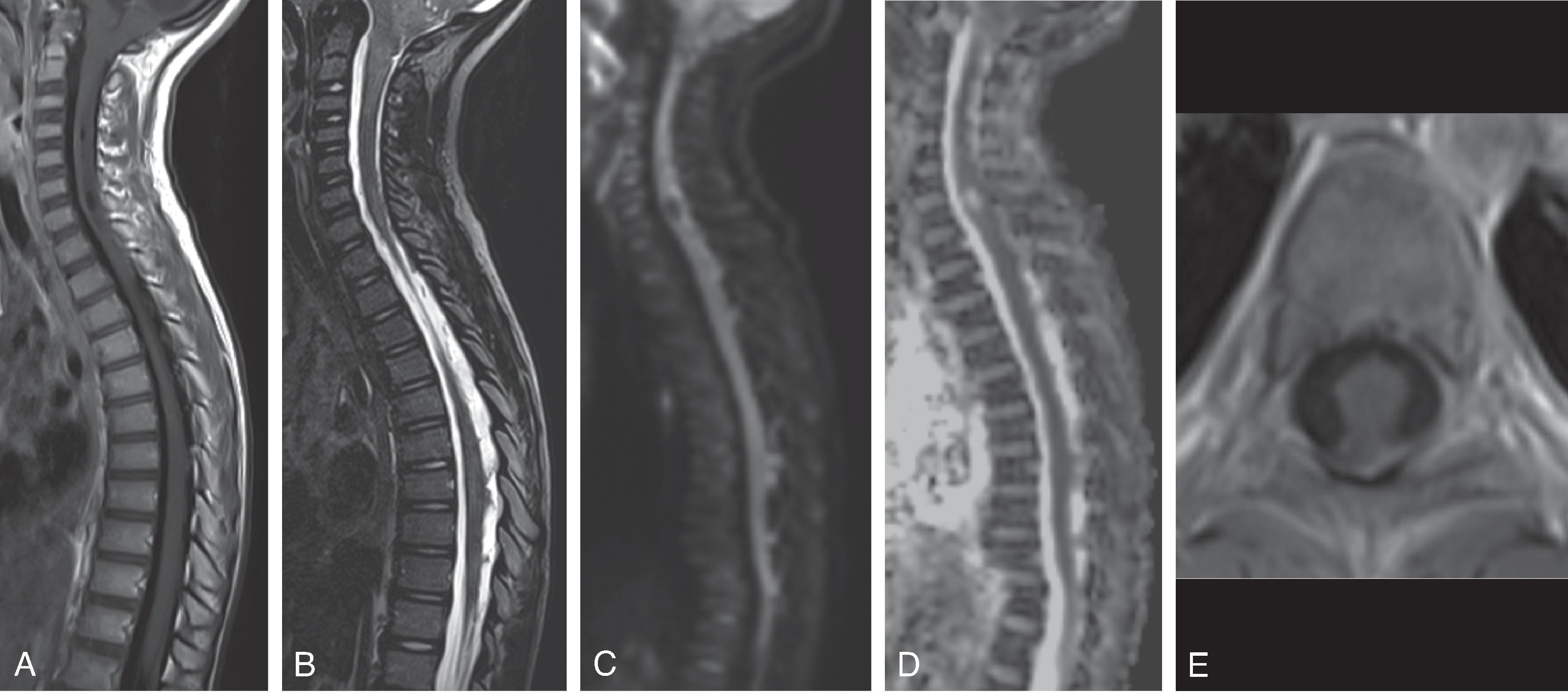 Fig. 17.13, CSF Metastases.