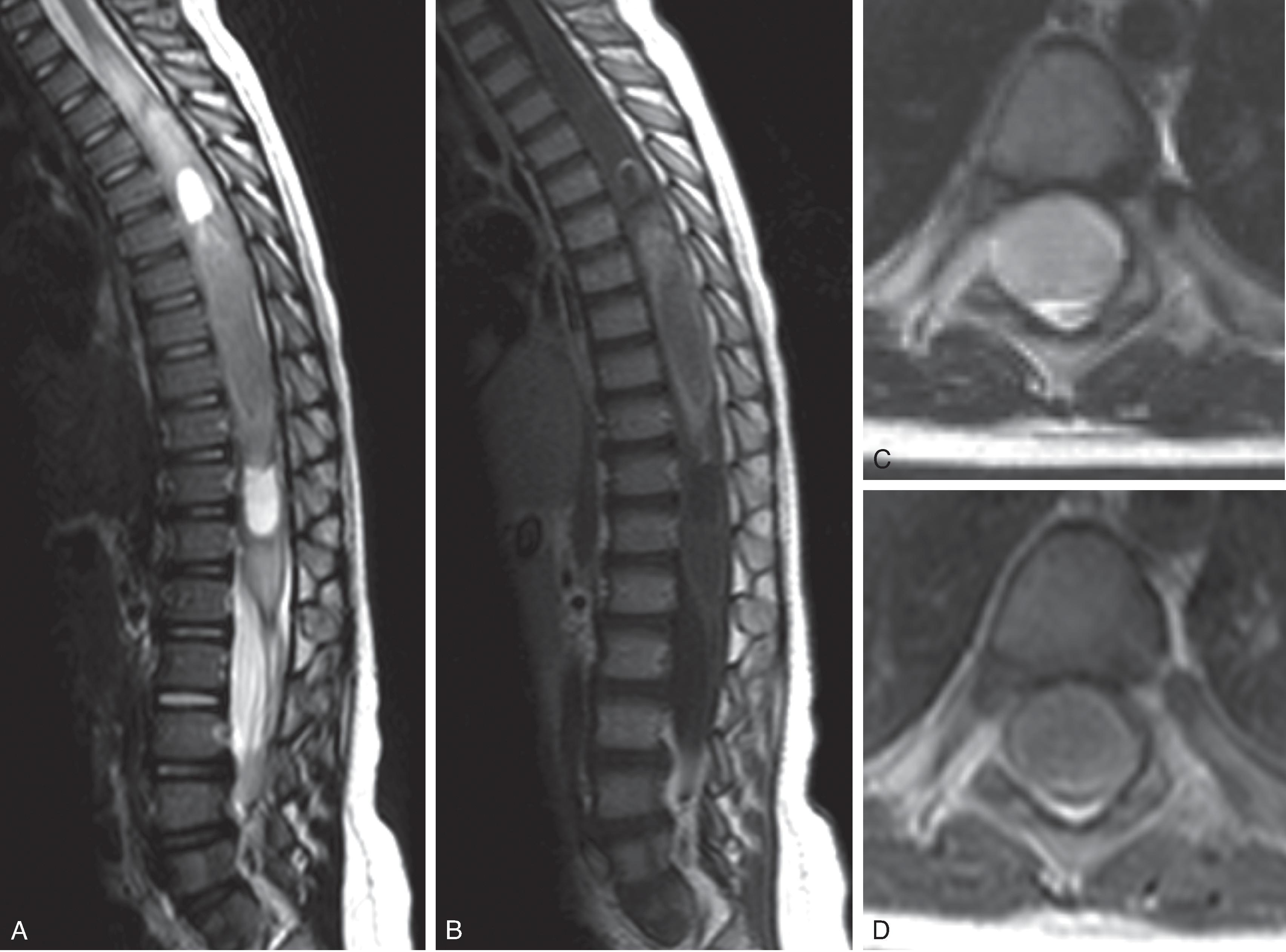 Fig. 17.5, Spinal Cord Ganglioglioma.