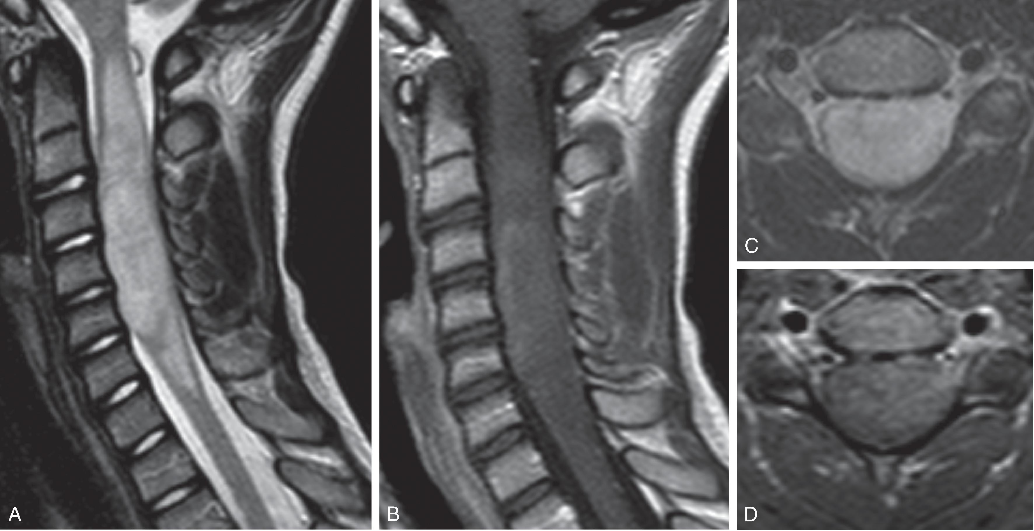 Fig. 17.2, Spinal Cord Low-Grade Astrocytoma.