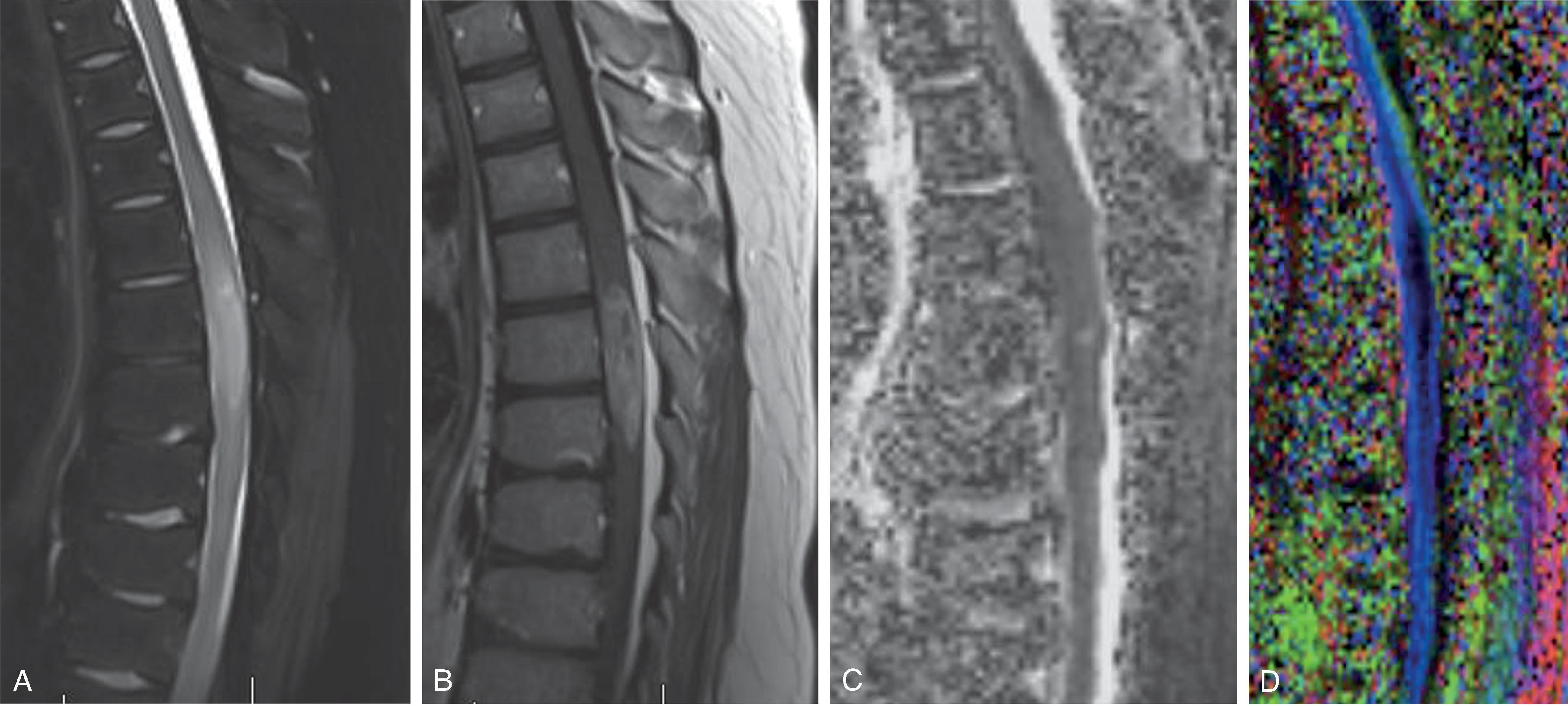 Fig. 17.6, Spinal Cord High-Grade Midline Glioma.