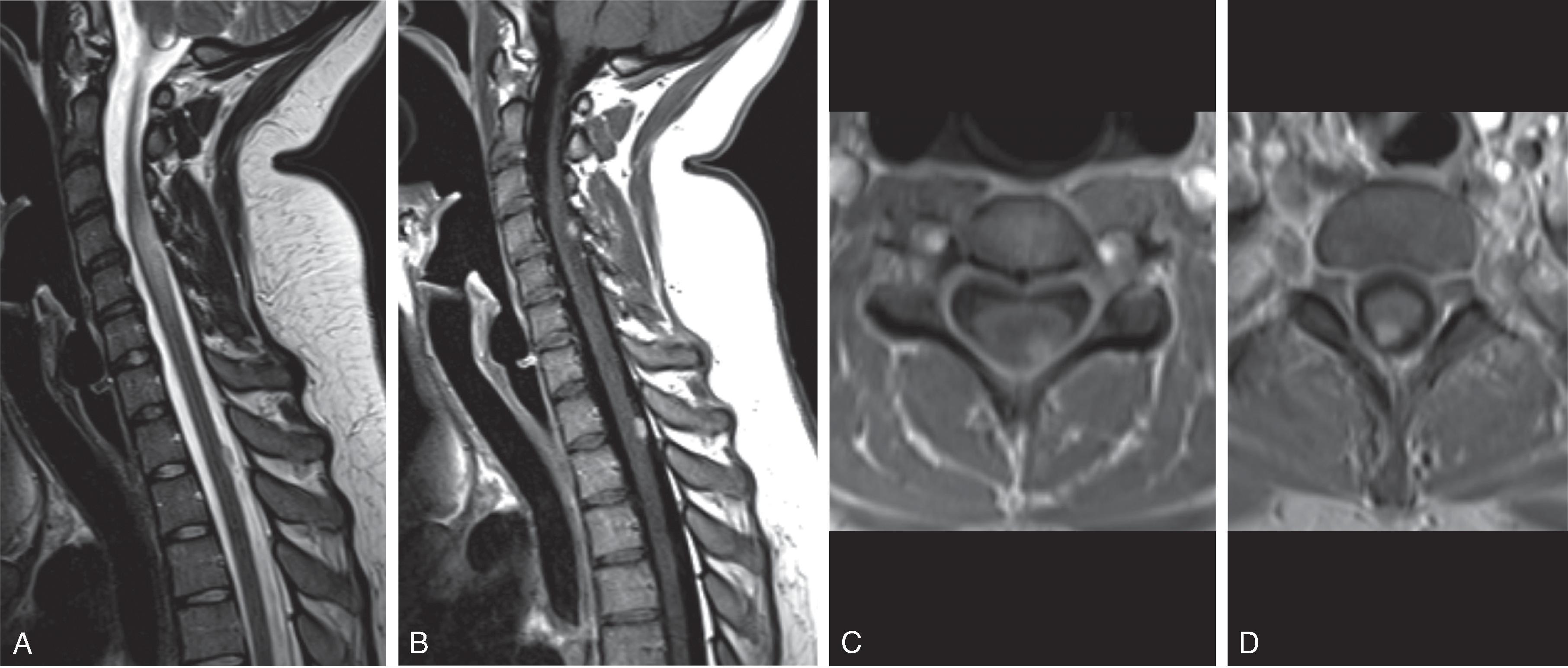 Fig. 17.7, Hemangioblastoma.