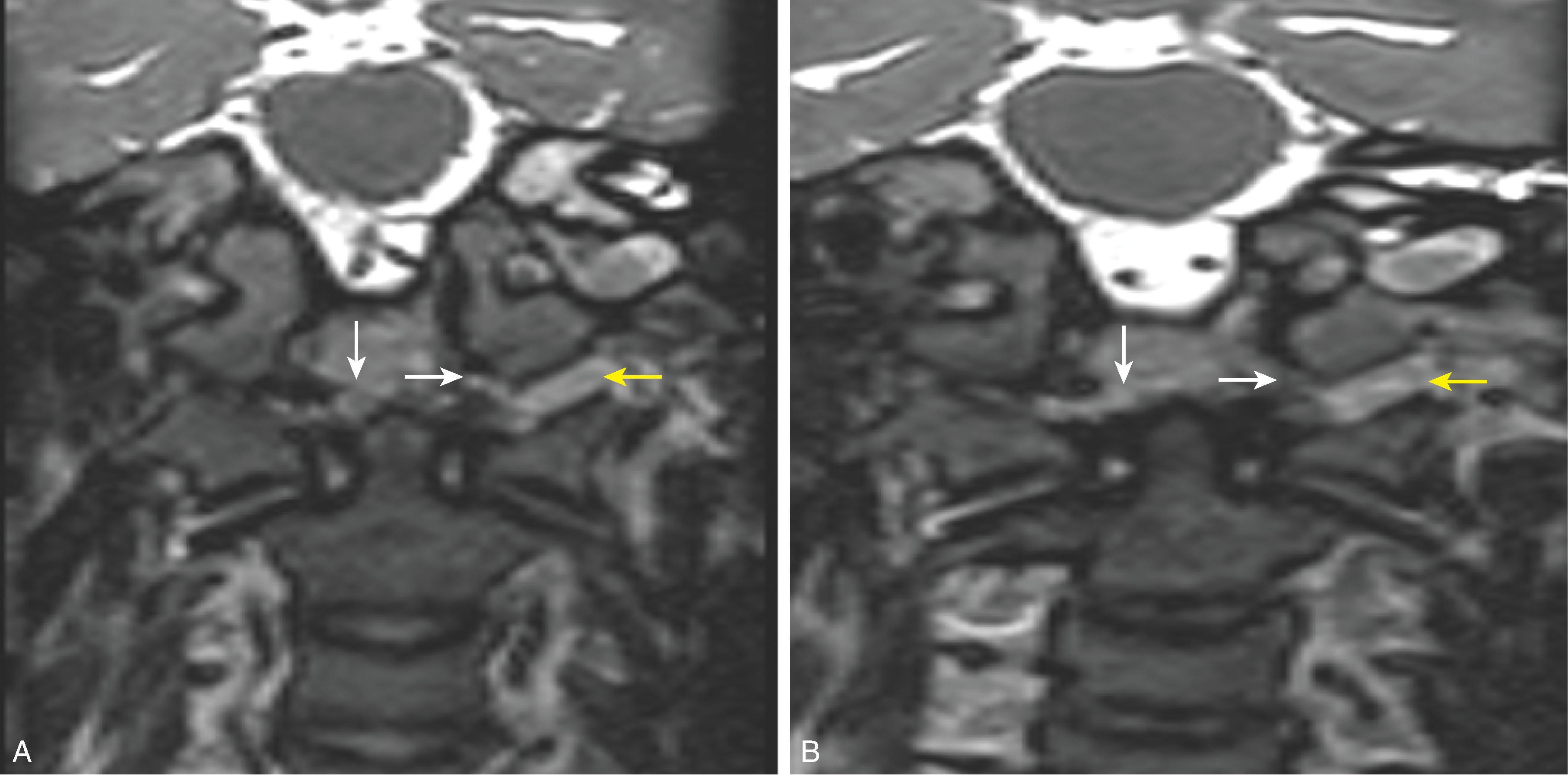 Fig. 19.3, Craniocervical Junction Ligamentous Injury. (A and B) Coronal T2W images demonstrate disruption of bilateral alar ligaments (white arrows) and a widened left condylar gap (yellow arrow) .