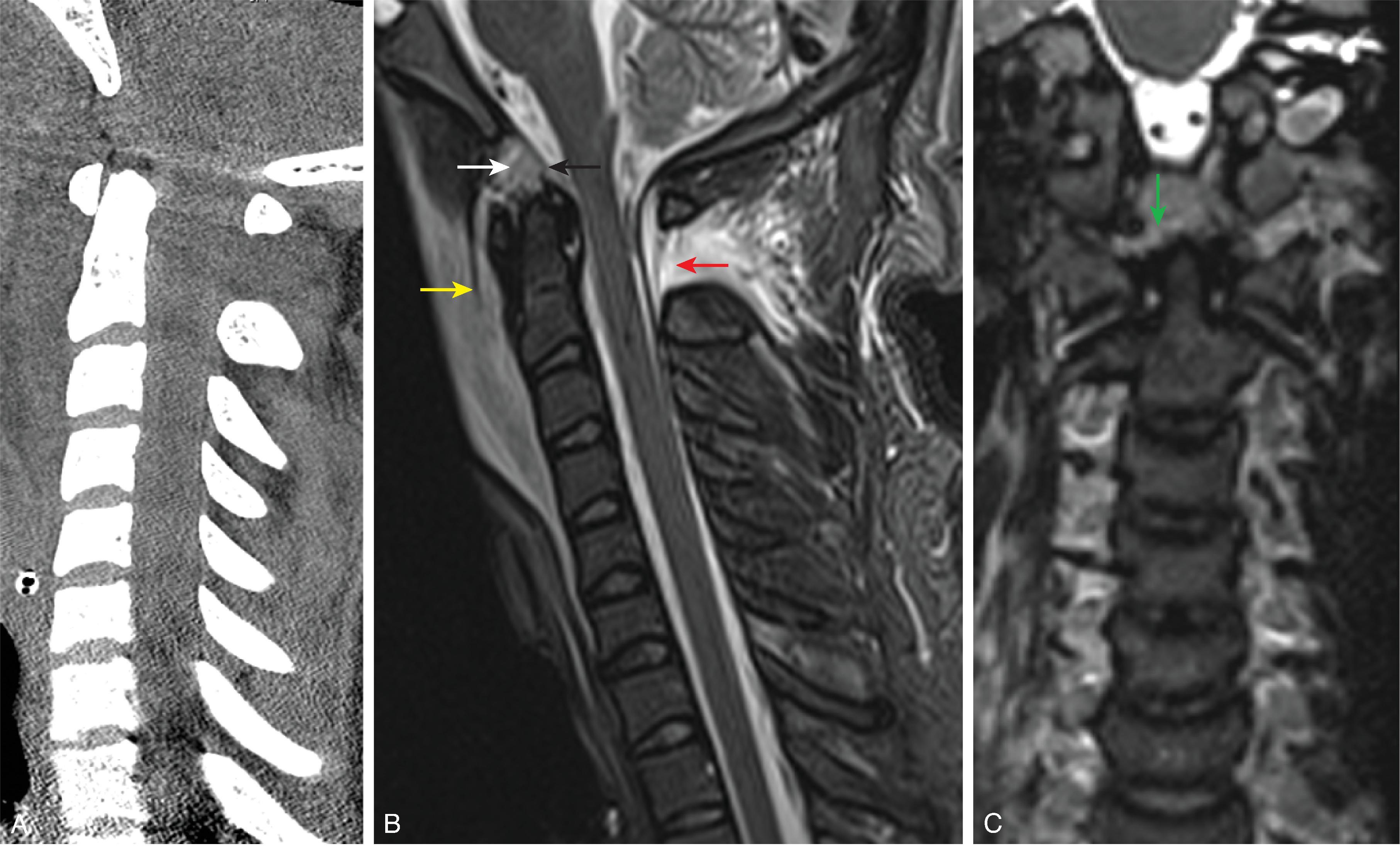 Fig. 19.4, Craniocervical Junction Ligamentous Injury. (A) sagittal reformat CT, (B) sagittal STIR, and (C) coronal 3D T2W images demonstrate prevertebral swelling, basion-dens interval greater than 10 mm, widened C1–C2 interspinous space, ligamentous injury of the anterior atlantooccipital ligament (yellow arrow) , apical ligament (white arrow) , tectorial membrane (black arrow) , posterior atlantoaxial ligament (red arrow) , and right alar ligament (green arrow) .