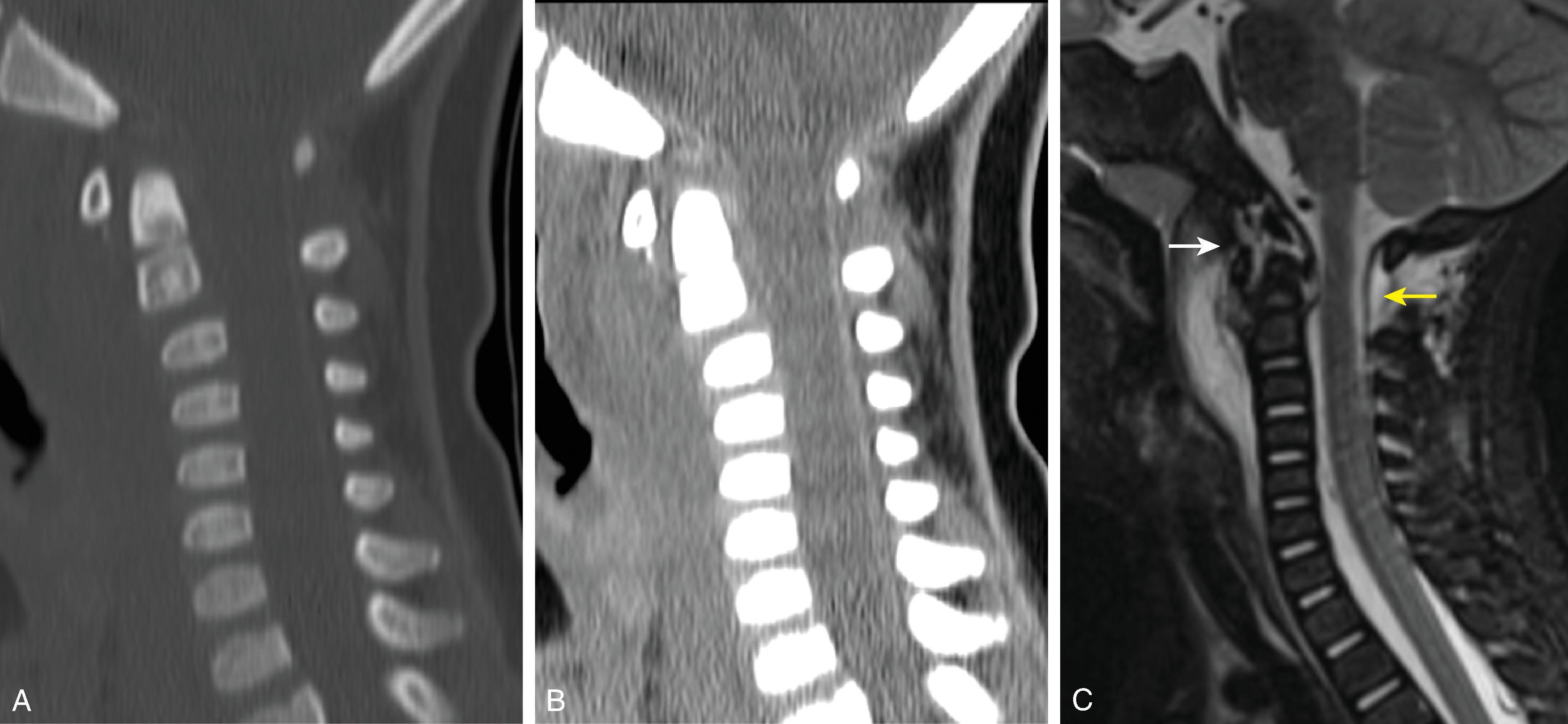 Fig. 19.5, Craniocervical Junction Ligamentous Injury. (A and B) Sagittal reformat CT images and (C) sagittal STIR image demonstrate prevertebral edema and ligamentous injury of the anterior longitudinal ligament, anterior atlantooccipital ligament (white arrow) , and posterior atlantoaxial ligament (yellow arrow) .