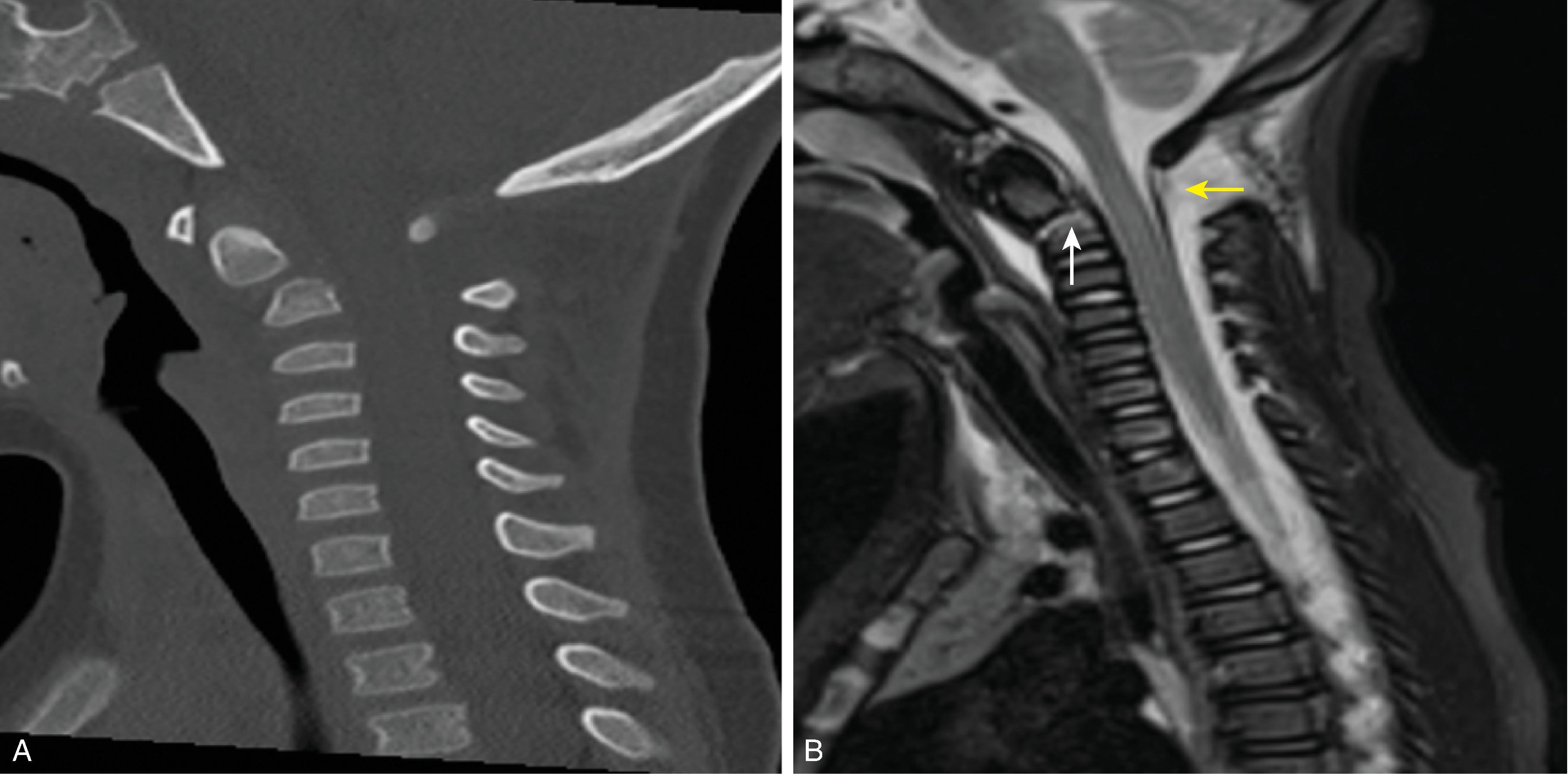 Fig. 19.8, C2 Synchondrosis Fracture. (A) Sagittal reformat CT and (B) sagittal T2W images demonstrate abnormal anterior tilt of the odontoid, abnormal edema along the C2 synchondrosis (white arrow) , prevertebral edema, and widening of the C1–C2 interspinous space from ligamentous injury of the posterior atlantoaxial ligament (yellow arrow) .