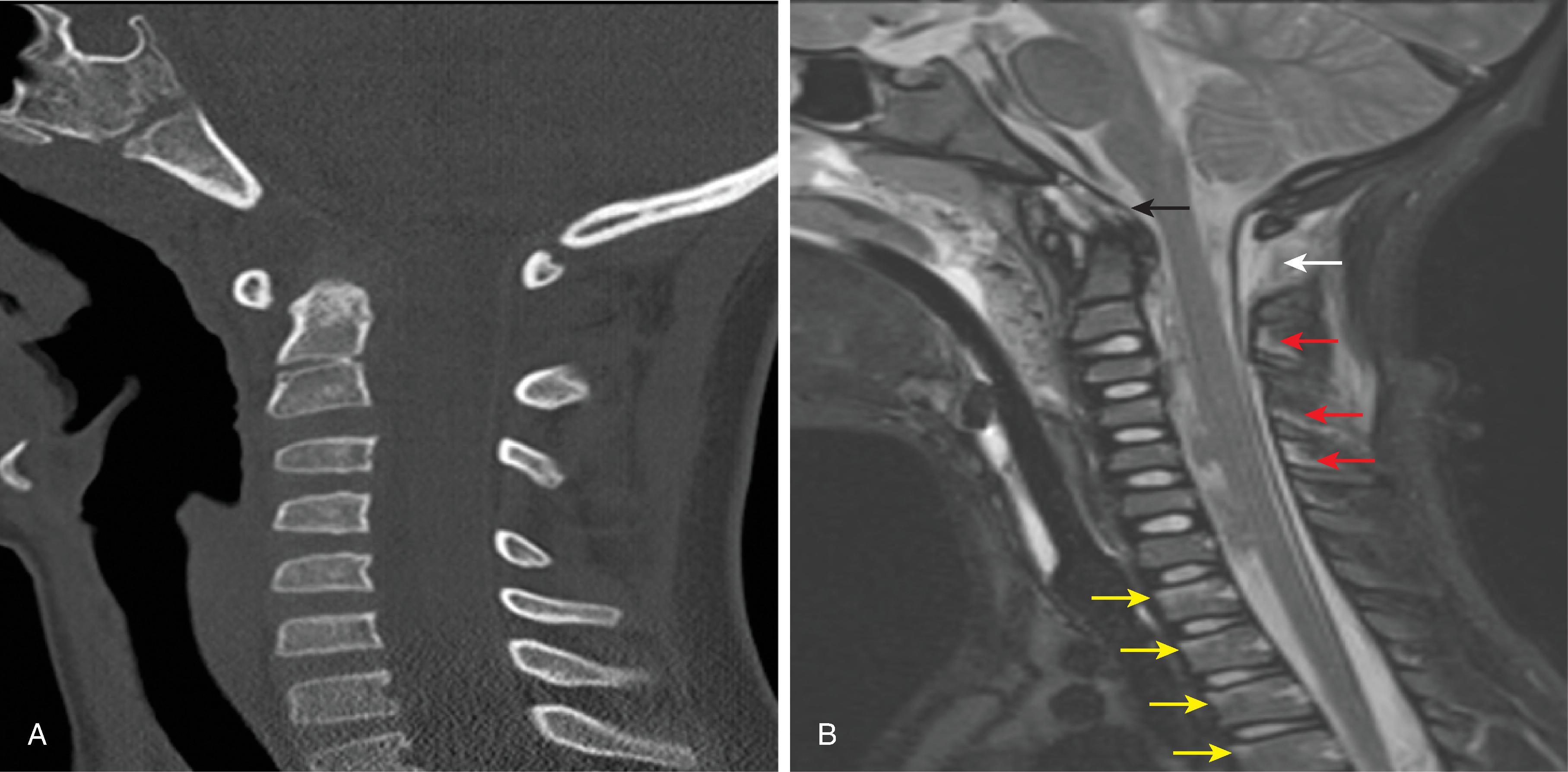 Fig. 19.6, Craniocervical Junction Ligamentous Injury. (A) Sagittal reformat CT and (B) sagittal T2W images demonstrate abnormal basion dens interval greater than 10 mm, widened C1–C2 and C3–C4 interspinous spaces, ligamentous injury of the posterior atlantoaxial ligament (white arrow) , tectorial membrane (black arrow) , probable apical ligament disruption, interspinous ligaments of C2–3, C3–4, and C4–5, and trabecular microfractures of thoracic vertebrae (yellow arrows) .