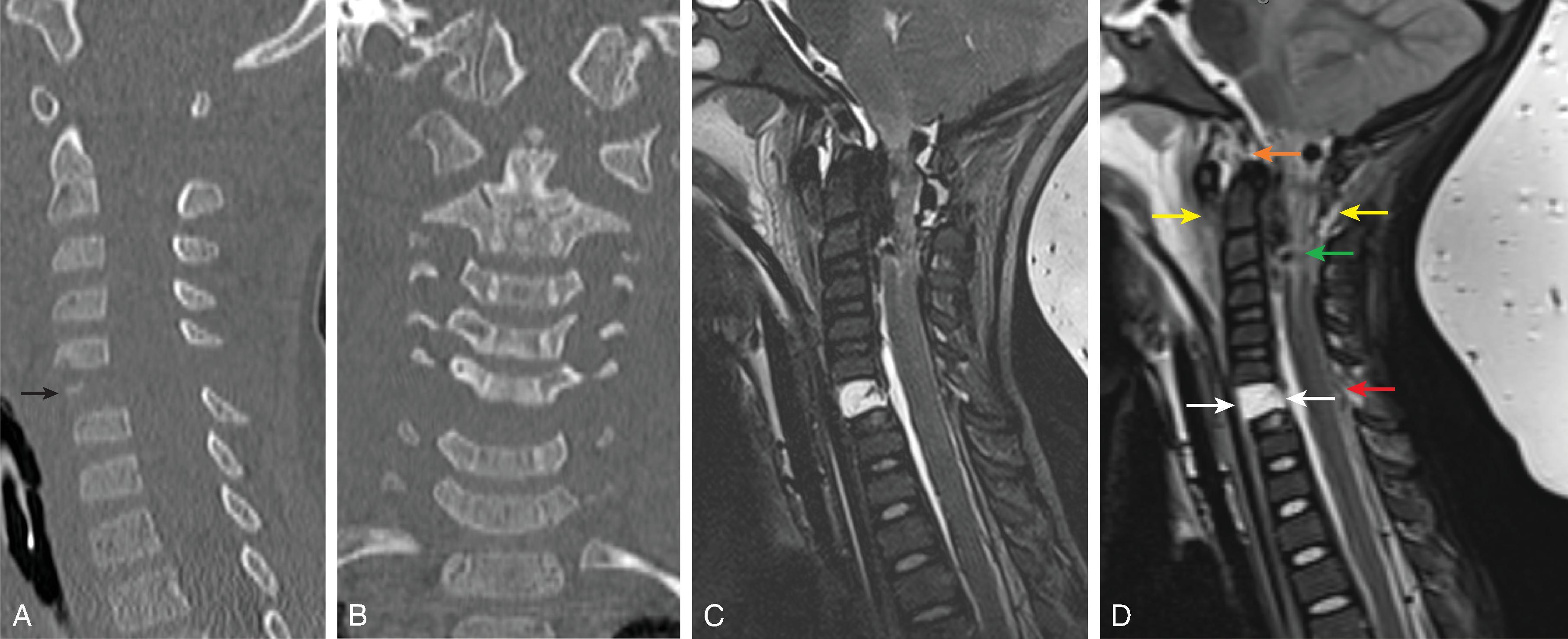 Fig. 19.7, Craniocervical Junction Ligamentous Injury. (A and B) Sagittal and coronal reformat CT and (C and D) sagittal T2W images demonstrate prevertebral edema, spinal cord injury with hemorrhage (green arrow) , ligamentous injury of the anterior atlantooccipital ligament, anterior and posterior atlantoaxial ligaments (yellow arrows) , apical ligament (orange arrow) , left alar ligament (not shown except for small avulsion fragment on coronal CT), widened facet joints indicative of facet capsular ligament tears at occipital–C1 and C1–C2, C5–6, anterior and posterior longitudinal ligament tear (white arrows) , widened interspinous space due to interspinous ligament and ligamentum flavum tears at C5–6 (red arrow) , and intervertebral disc transection and endplate avulsions at C5–6 (black arrow) .