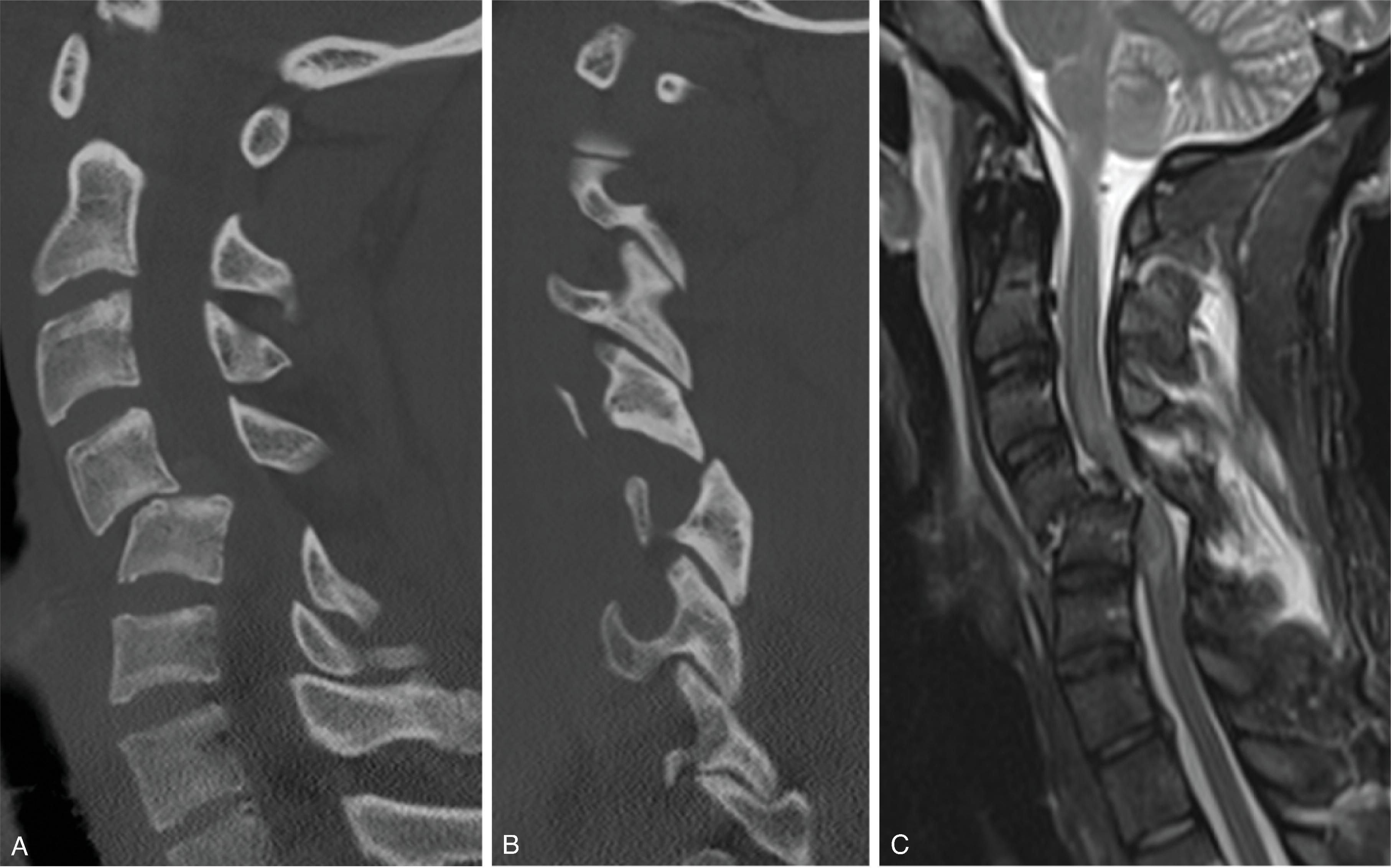 Fig. 19.9, Facet Dislocation. (A and B) Sagittal reformat CT and (C) sagittal T2W images demonstrate malalignment with C4–C5 anterolisthesis, narrowed C4–C5 disc space, prevertebral edema, ligamentous injury of the anterior and posterior longitudinal ligaments, C3–C4 and C4–C5 interspinous ligaments, disc herniation, spinal cord compression, and cord edema.