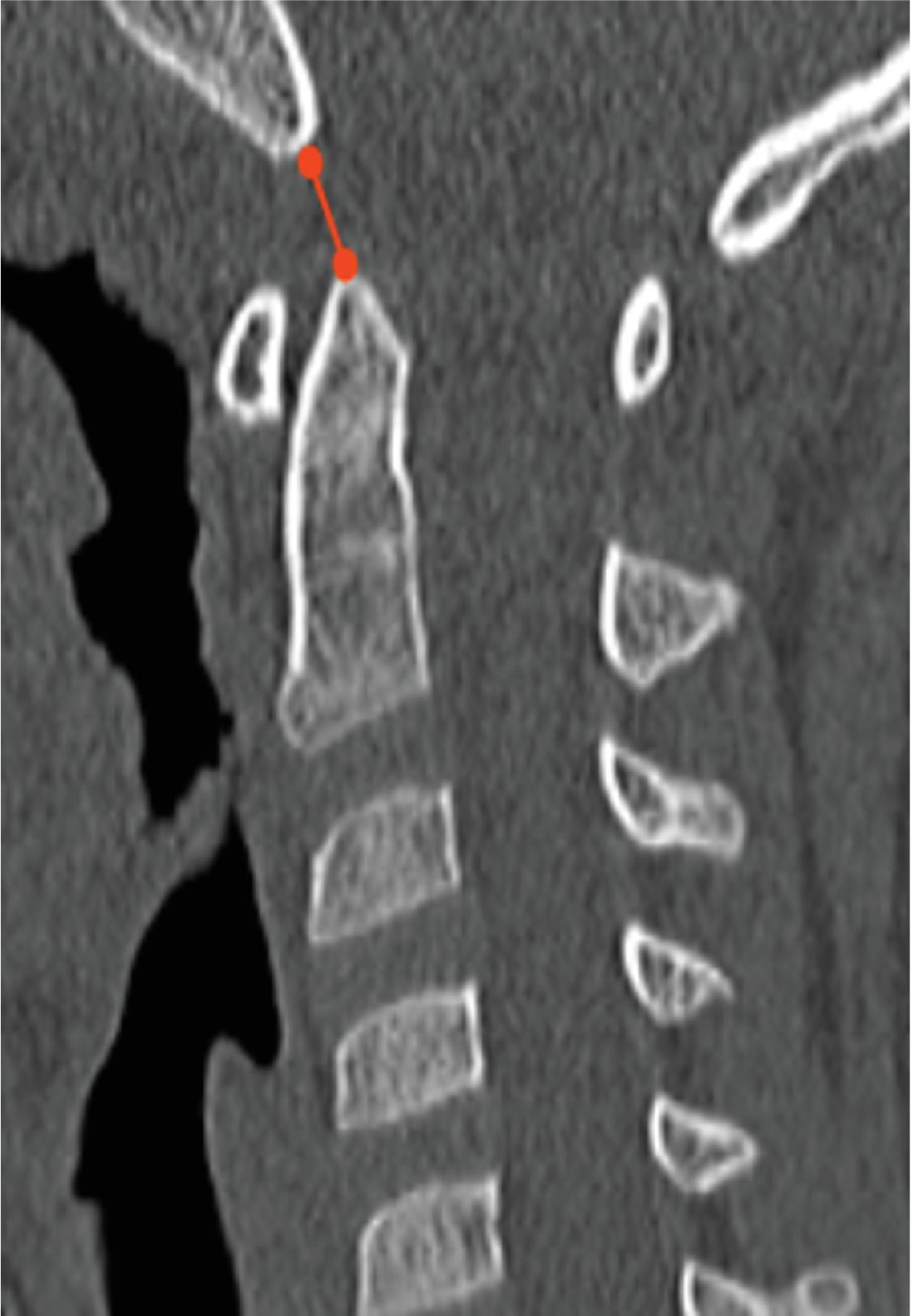 Basion-Dens Interval (BDI). Measured as the shortest distance between the basion and the tip of the ossified odontoid process of C2. Normal <10 mm. Alternatively, the basion-cartilaginous dens interval can be used in children with incomplete ossification.