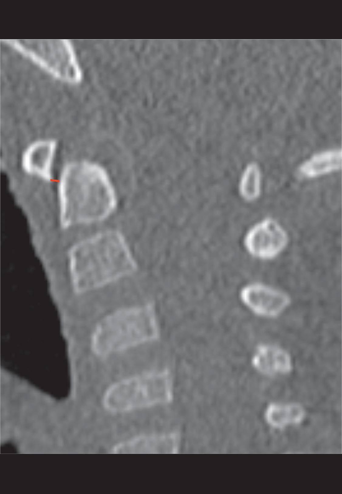 Atlantooccipital Interval. The largest of five perpendicular measurements between the occipital condyle and C1 on a lateral sagittal image on each side. The anterior intraoccipital synchondrosis should not be in the measurement. Normal < 2.5 mm.