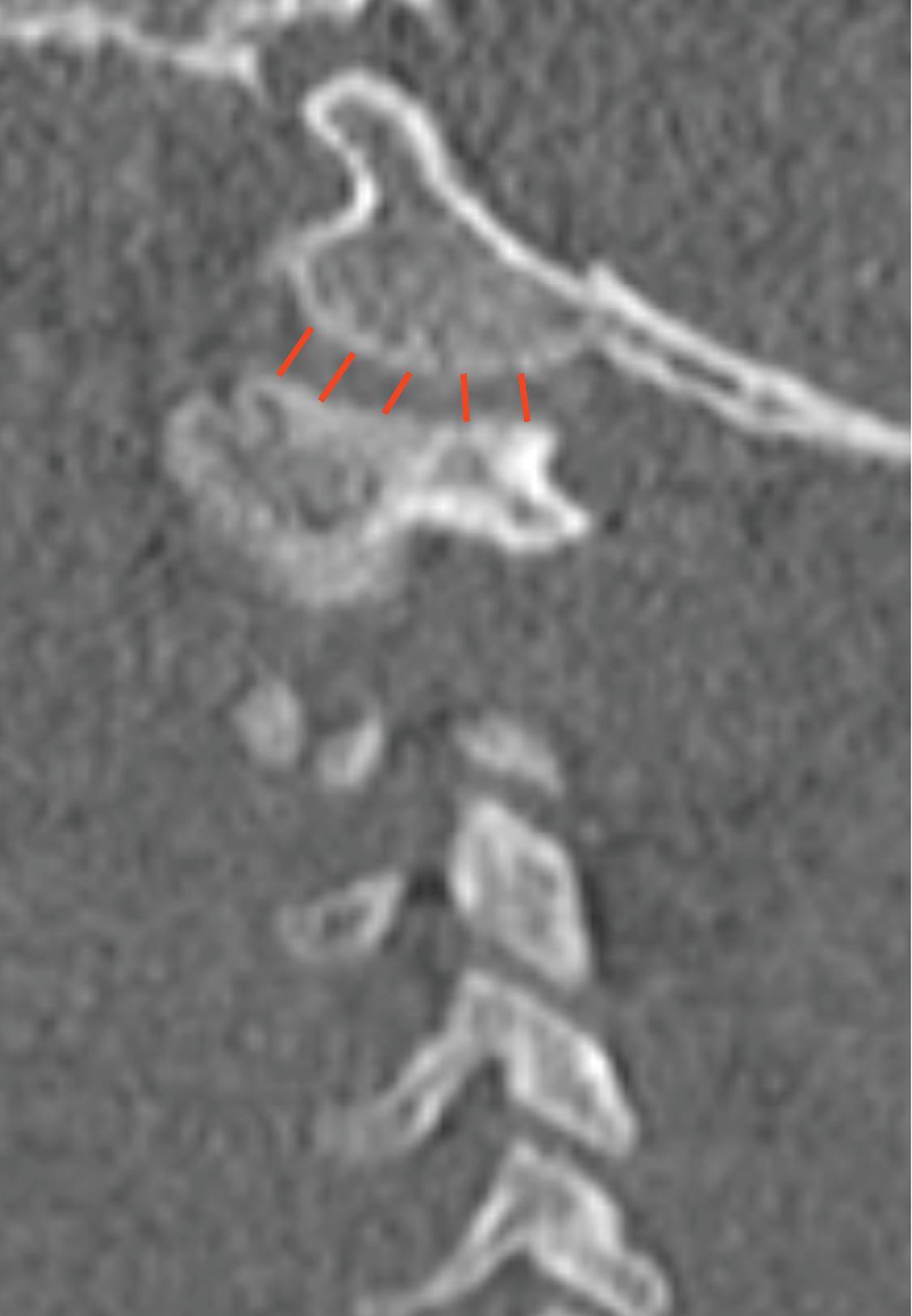 Anterior Atlantodental Interval (ADI). Measured as the distance between the inferior posterior margin of the anterior arch of C1 and the anterior margin of the odontoid process. Normal <2.5 mm.