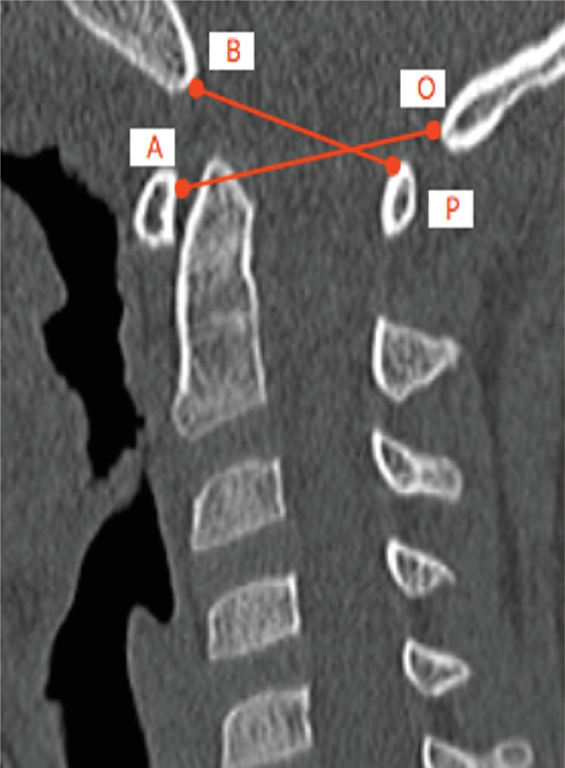 Atlantoaxial Interval. Measured as the shortest perpendicular distance between the lateral masses of C1 and C2 on each side. Normal <3.9 mm.