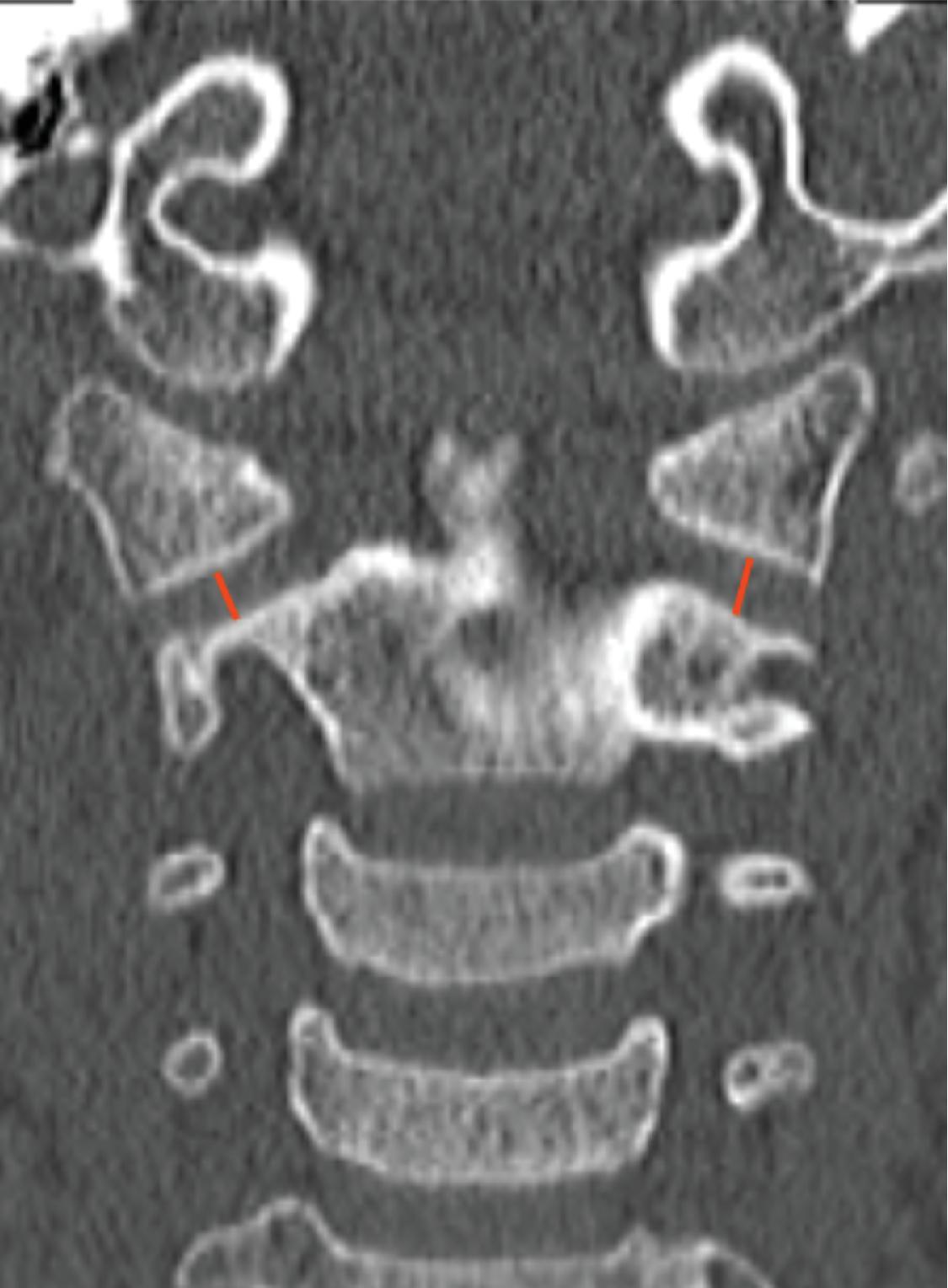 Prevertebral Soft Tissue Thickness. Measured at C2 as the narrowest distance between the posterior wall of the trachea and the anterior margin of the C2 vertebral body. Normal <6 mm.