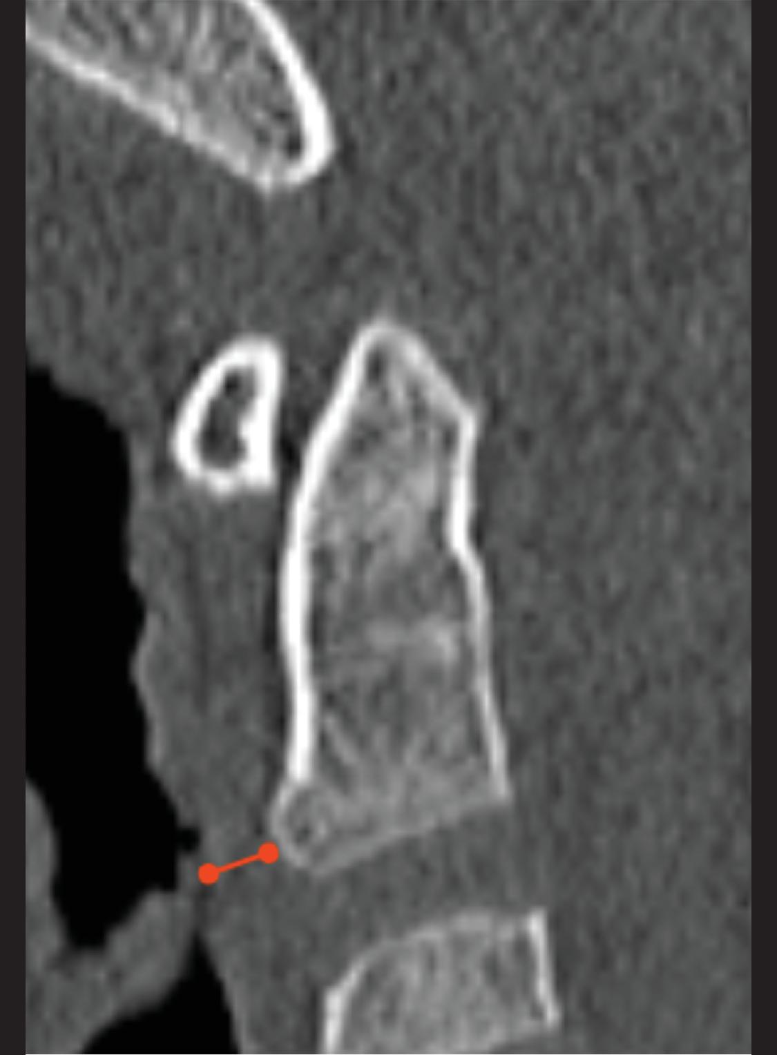 Craniocervical Junction Ligament Anatomy. (A) Coronal 3D T2W image demonstrating the alar ligaments (yellow arrows) , transverse ligaments (red arrows) , and expected location of the apical ligament (blue line) . (B) Sagittal 3D T2W image demonstrating the apical ligament (blue arrow) , tectorial membrane (yellow arrow) , anterior and posterior atlantooccipital ligaments (red) , anterior and posterior atlantoaxial ligaments (light green arrows) , anterior and posterior longitudinal ligaments (white arrows) , and ligamentum flavum and interspinous ligaments (dark yellow arrow) . Determination of intact versus disrupted status of these ligaments is important for determination of ligamentous injury. (C) Diagram of a posterior view of the CCJ; the posterior elements have been removed and ligaments are demonstrated. In the center of the image lies the cruciate ligament. (D) Diagram of a cross-sectional view of the craniocervical junction (CCJ) demonstrating the ligamentous anatomy. (C and D from Boll DT, Haaga JR: CT and MRI of the whole body , 6th ed, Philadelphia, 2017, Elsevier.)