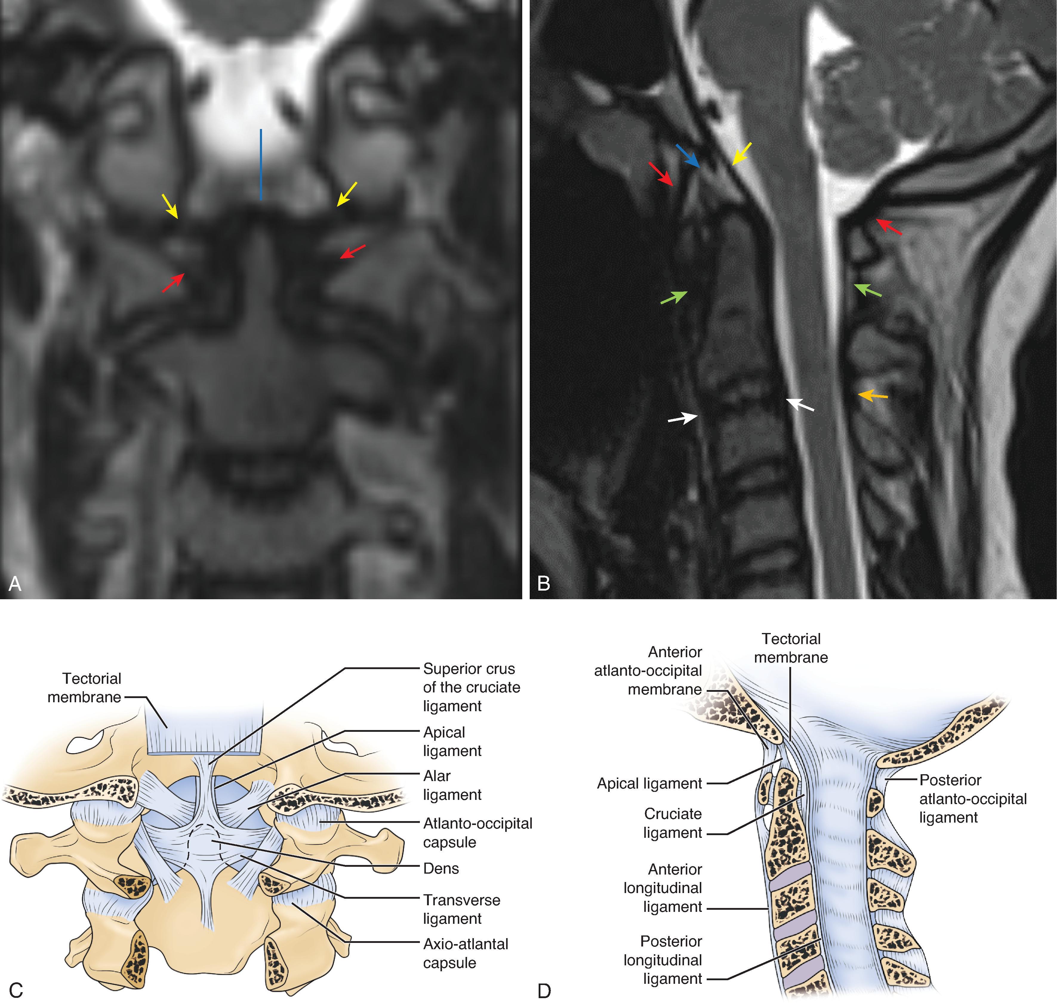 Powers Ratio. Measured as the distance between the basion and anterior margin of the posterior arch of C1, divided by the distance between the opisthion and the posterior margin of the anterior arch of C1. Normal <1