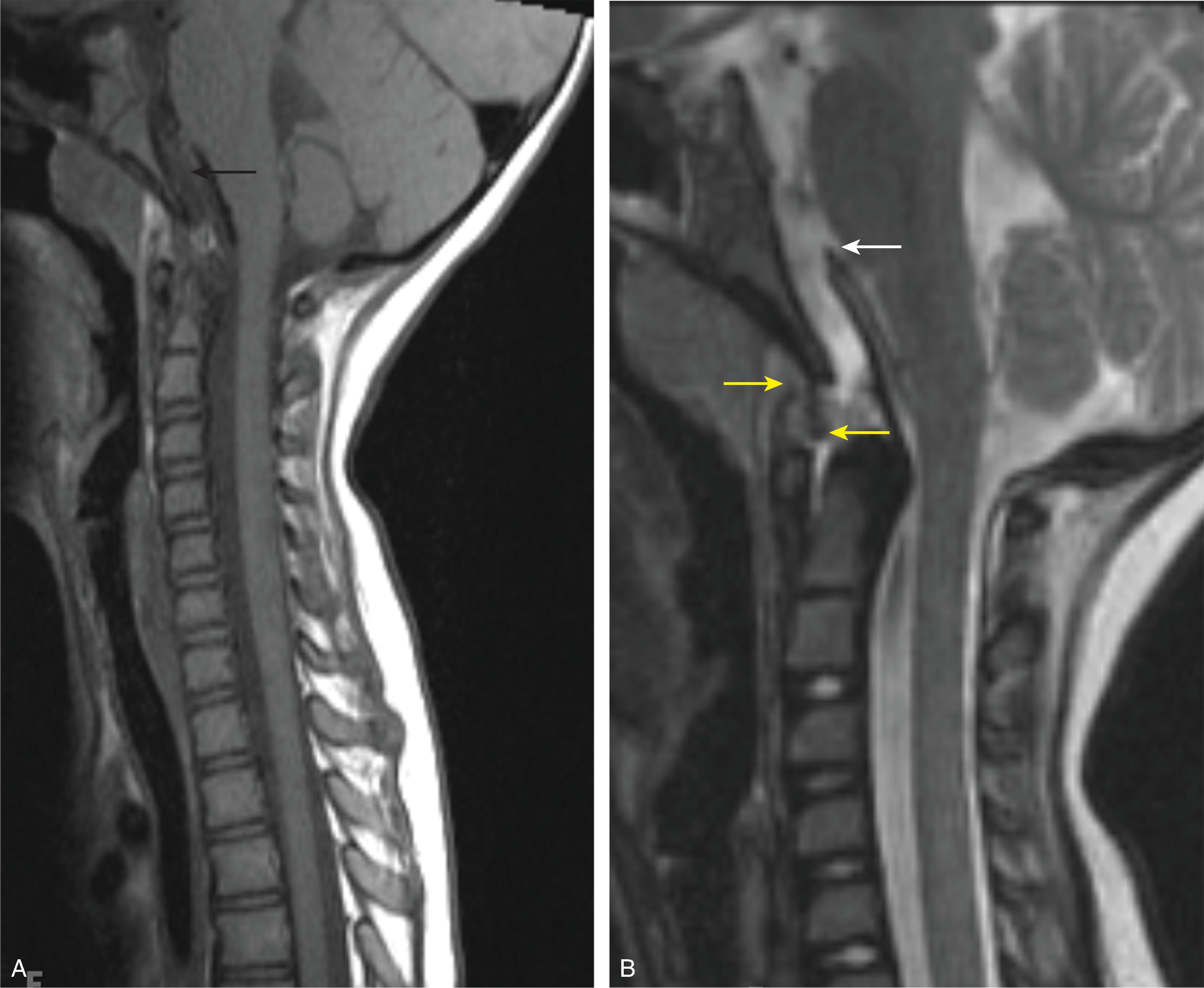 Fig. 19.1, Craniocervical Junction Ligamentous Injury. (A) Sagittal T1W and (B) sagittal T2W images demonstrate disruption of the tectorial membrane (white arrow) , apical ligament and anterior atlantooccipital ligament (yellow arrows) , and retroclival hematoma (black arrow) .