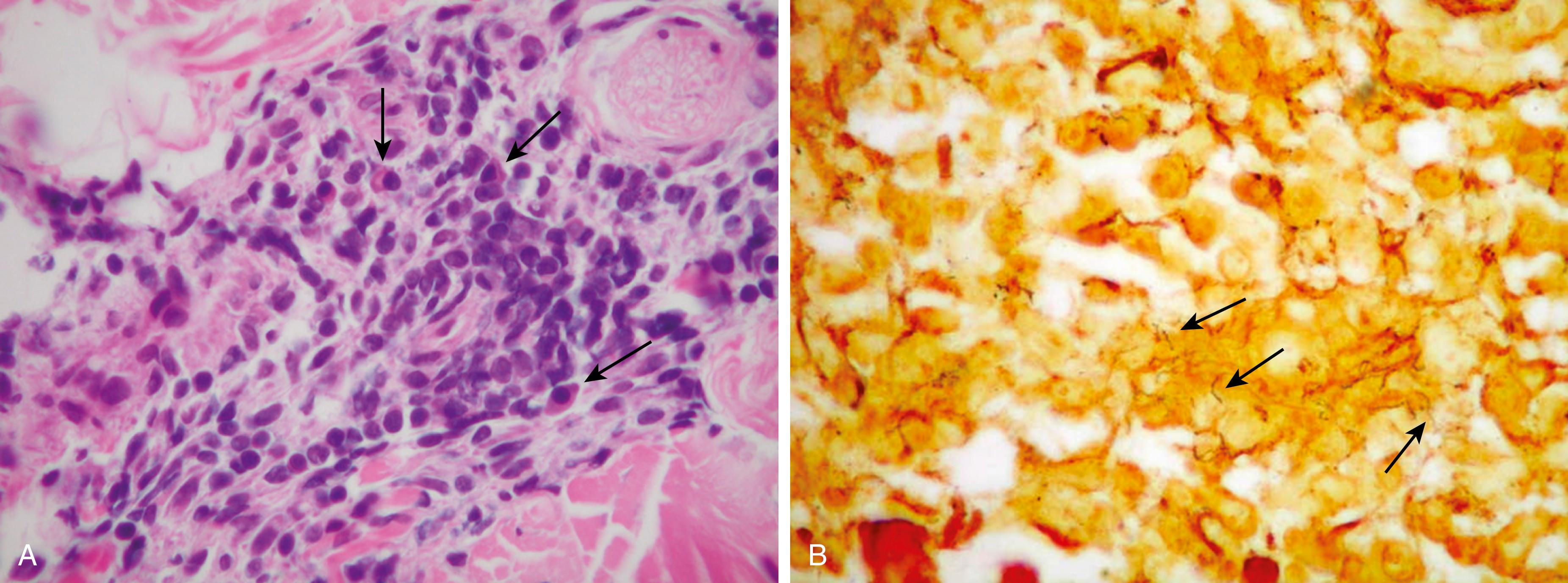 Fig. 61.3, Histologic photomicrographs of a secondary syphilis case. A Superficial dermis showing a dense, perivascular lymphomononuclear infiltrate containing many plasma cells (arrows) (hematoxylin & eosin [H&E], ≈400×), which was confirmed in B to contain numerous argyrophilic spirochetes (arrows) (Steiner silver impregnation technique, 400×). Patient was subsequently shown to have a high rapid plasma reagin (RPR) titer.