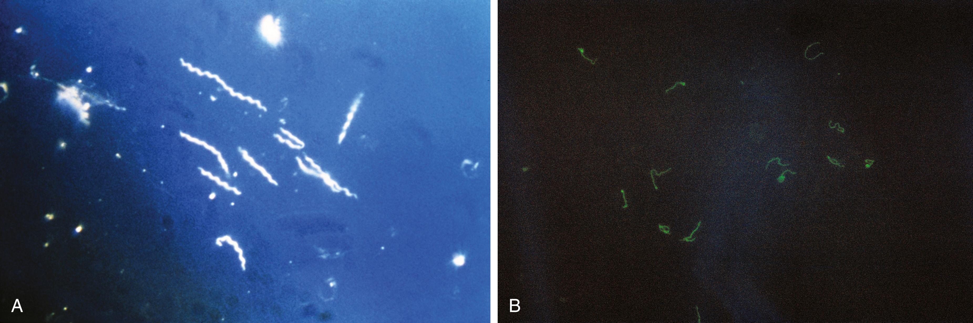 Fig. 61.5, In vitro diagnostic modalities for venereal syphilis detection. A Darkfield microscopy technique (400×) reveals the presence of motile spirochetes. B Positive fluorescent treponemal antibody absorption (FTA-ABS) test for antibody response in patient with syphilis.