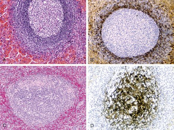 Figure 60-1, A , Splenic lymphoid follicle displaying its characteristic tripartite nature: germinal center, mantle zone, and well-defined marginal zone. B , DBA.44 immunohistochemical stain highlights mantle-zone cells. Note negative staining in the follicle germinal center and rare positive cells within the predominantly negative marginal zone. C , Hyperplastic follicle, with less distinct mantle and marginal zones. D , CD21 immunohistochemical stain highlights the follicular dendritic cell network within a germinal center.