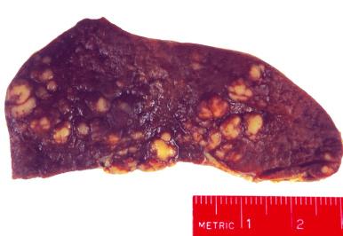 Figure 60-4, Gross photograph of Hodgkin's lymphoma involving the spleen.