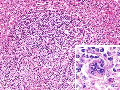 Figure 60-5, Early involvement of the spleen by Hodgkin's lymphoma.