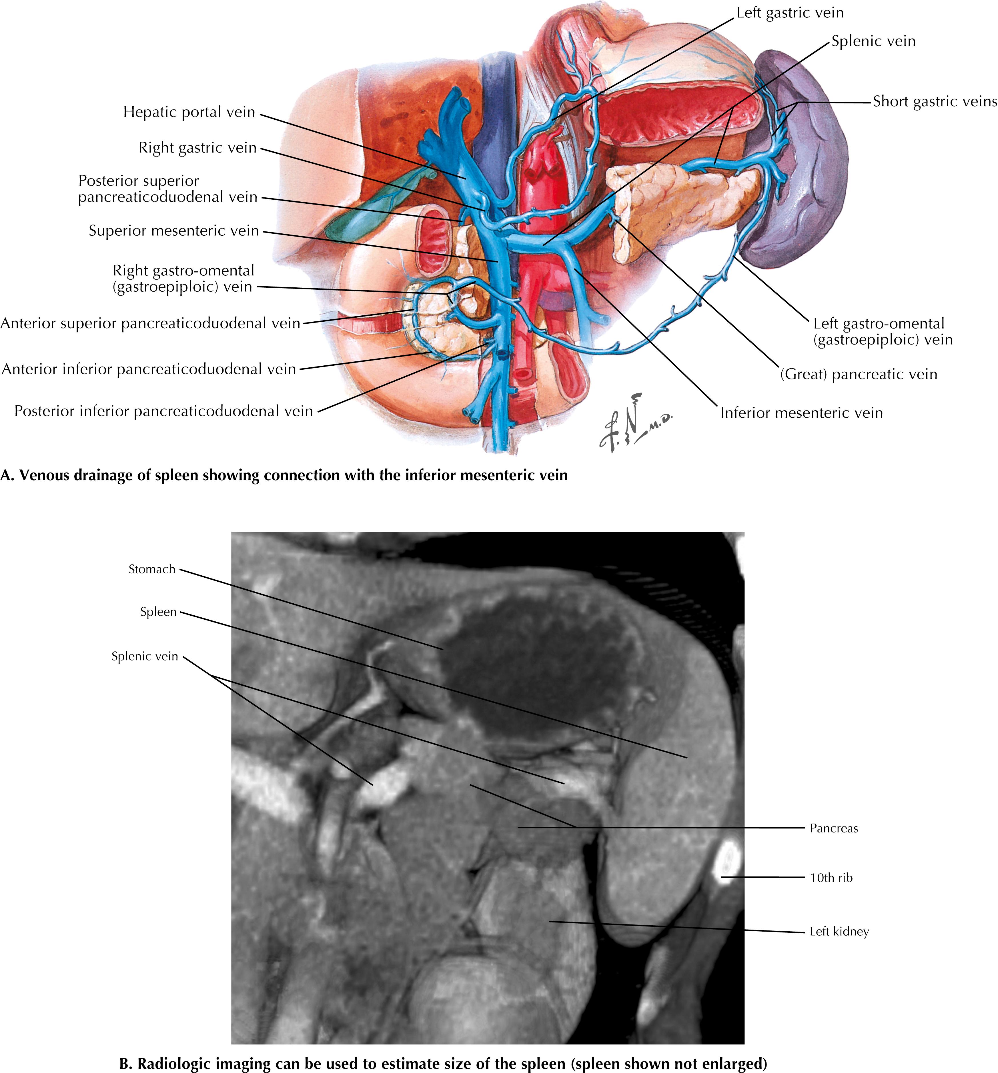 FIGURE 17.2, Venous anatomy and the resection bed in splenectomy.