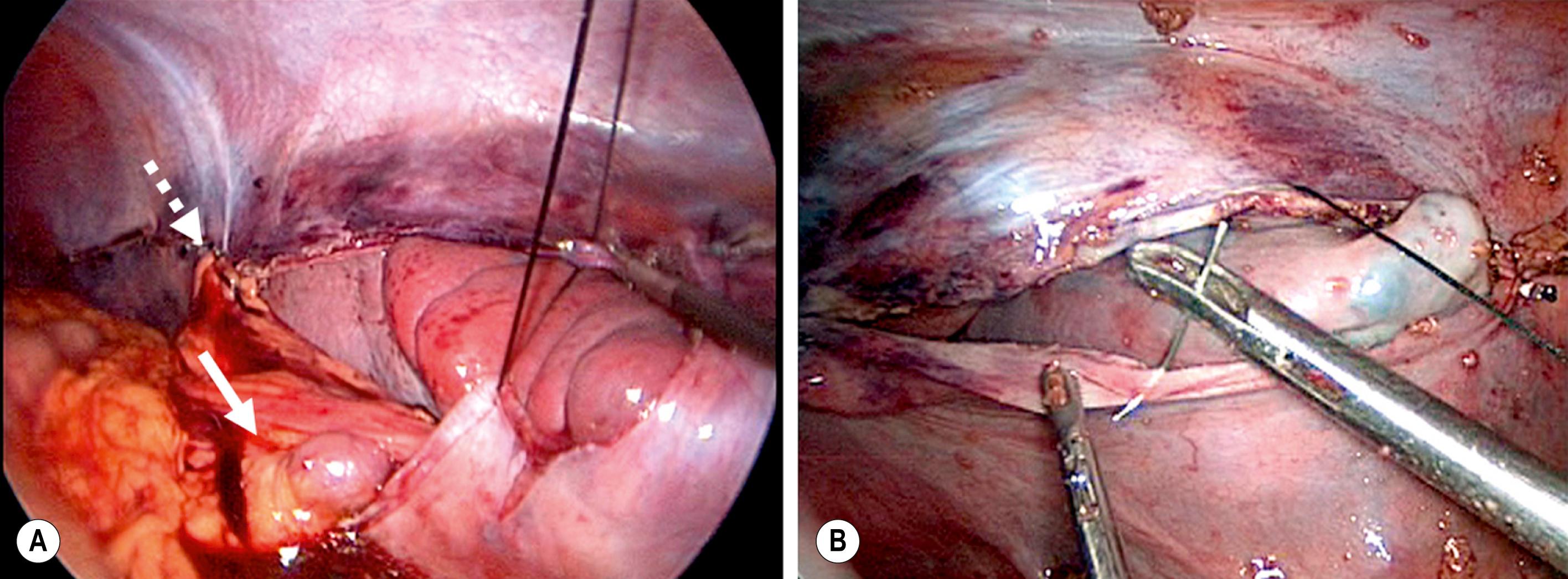 Fig. 47.2, (A) The upper pole of the spleen was placed in the retroperitoneal pouch, and the upper aspect of the pouch (dotted arrow) was closed with interrupted sutures. Note the splenic vessels (solid arrow) coursing into the spleen. A generous opening was left in the pouch for these vessels so that the vessels would not be compressed by closure of the pouch. (B) One of the interrupted silk sutures is being placed to approximate the peritoneal flaps over the spleen. At this point, most of the spleen has been placed into the extraperitoneal pouch.