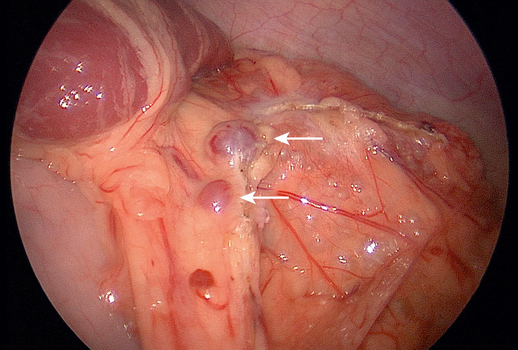 Fig. 47.3, In this child undergoing a laparoscopic splenectomy, two accessory spleens (arrows) are seen near the inferior edge of the spleen.