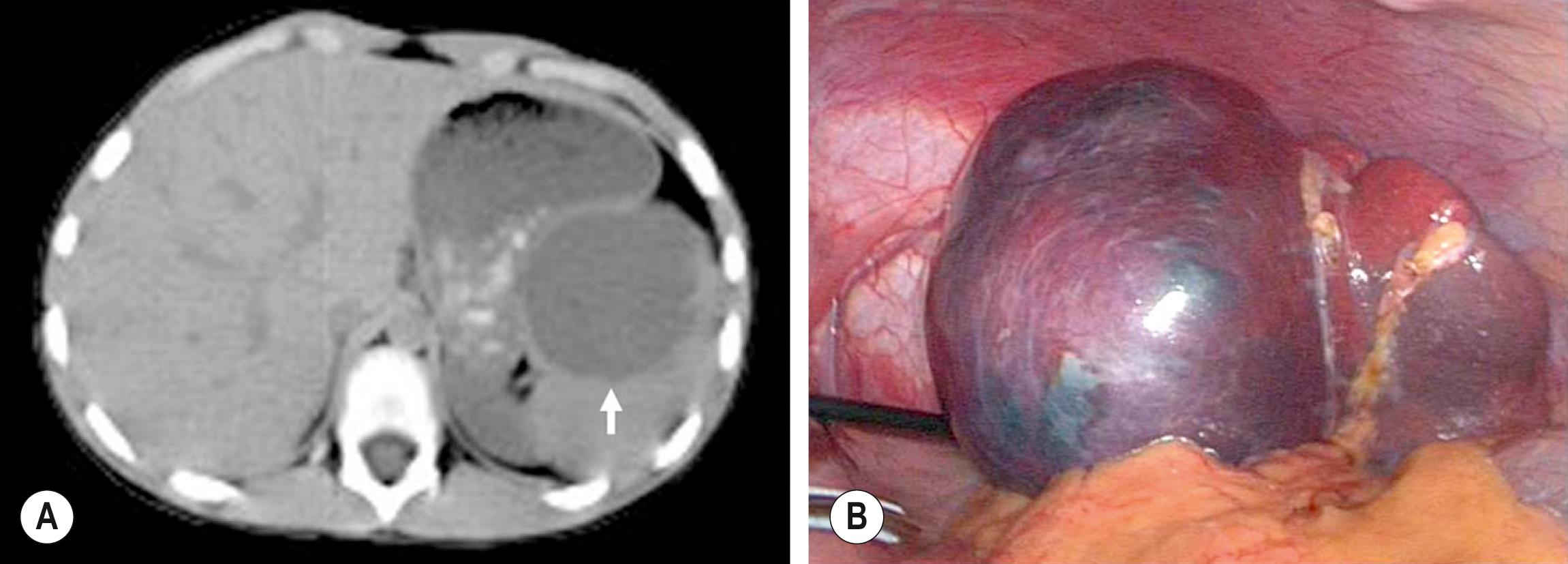 Fig. 47.4, (A) A large epithelial splenic cyst (arrow) is seen on the CT scan. (B) At laparoscopy, the large cyst (seen in [A] ) is seen to occupy most of the spleen.