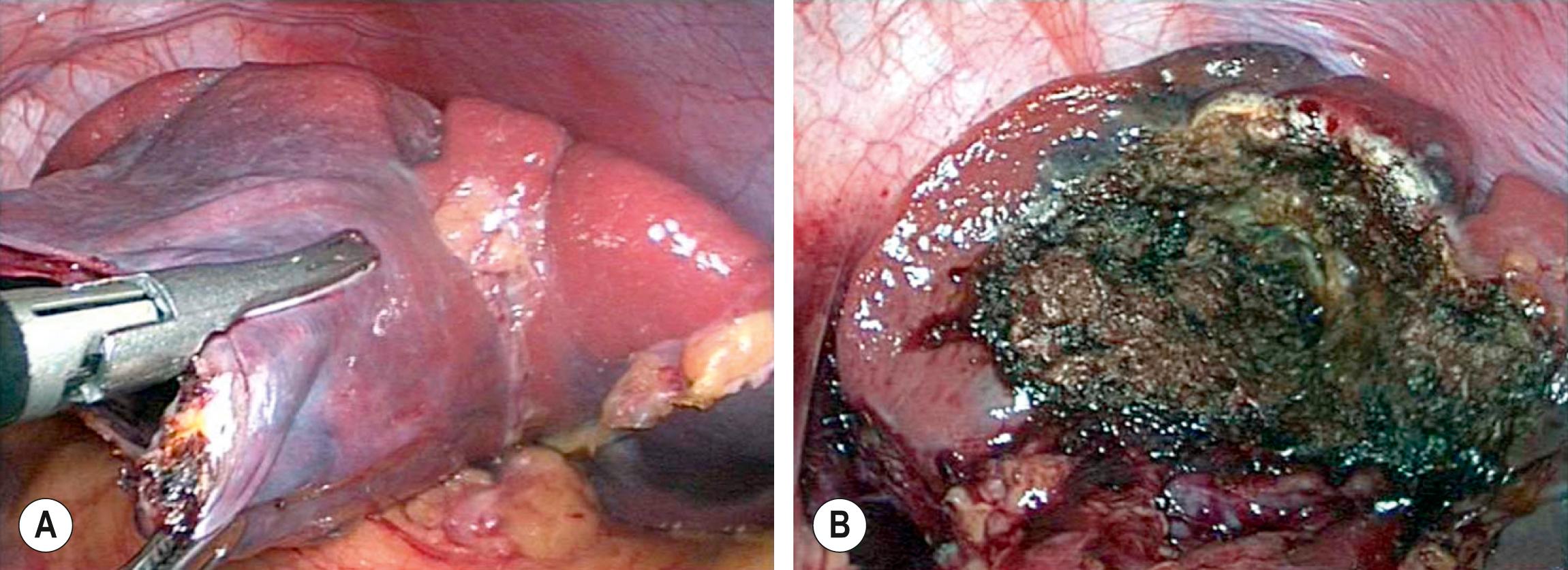Fig. 47.5, (A) The wall of the large epithelial splenic cyst seen in Figure 47.4 is being excised. (B) The cyst was marsupialized, and the remnant lining of the cyst was ablated with the argon beam coagulator.