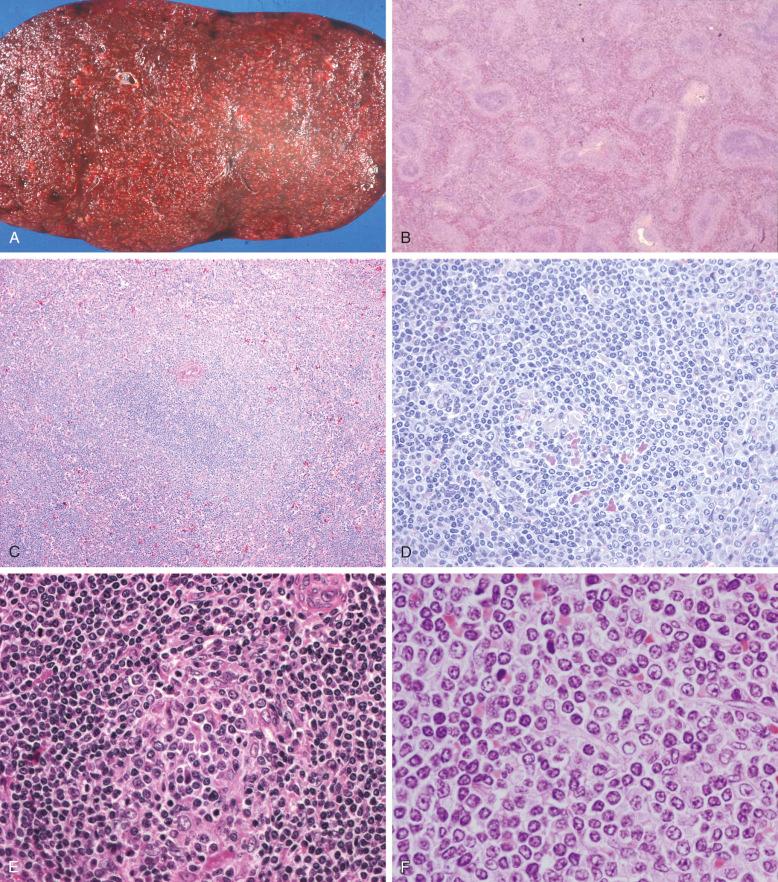 Figure 17-1, Splenic marginal-zone lymphoma morphology in the spleen.