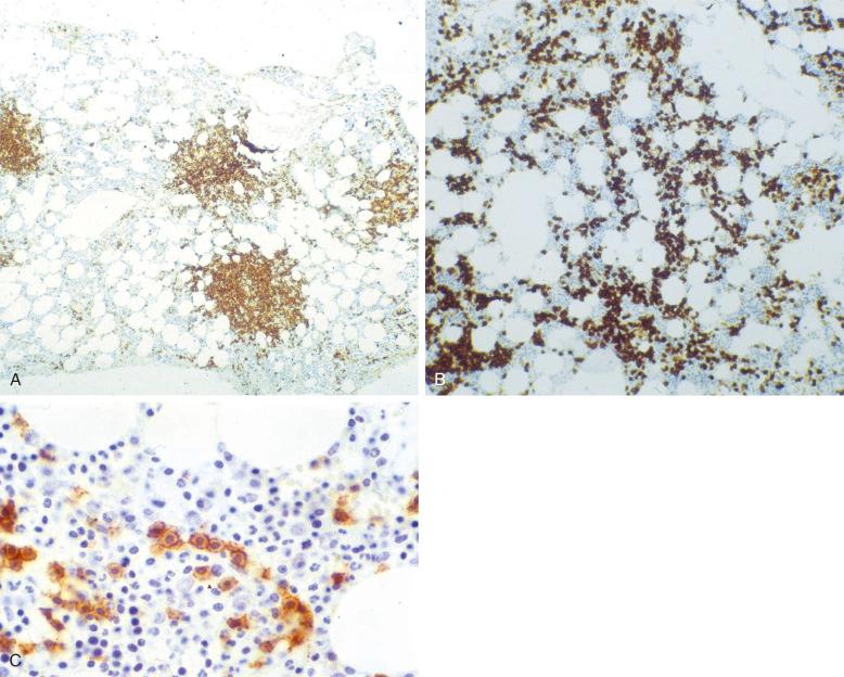 Figure 17-3, Bone marrow biopsy specimen shows the characteristic patterns of splenic marginal-zone lymphoma with CD20 staining. A, Low magnification shows nodular intertrabecular and intrasinusoidal tumor aggregates. B, Higher magnification shows diffusely scattered tumor cells. C, Intrasinusoidal tumor cells.