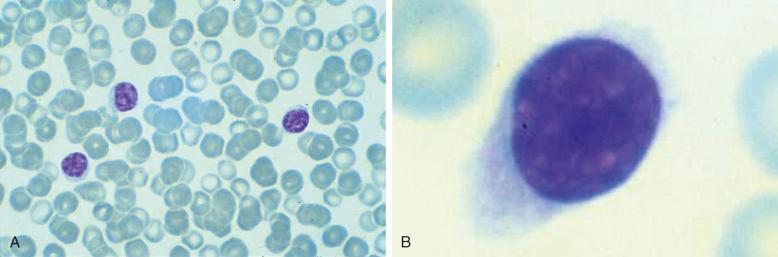 Figure 17-4, A and B, Peripheral blood morphology shows villous lymphocytes. Villi are typically short and are described as polar—that is, they are concentrated at one pole of the cytoplasm, in contrast to the longer, circumferential villi typically seen in hairy cell leukemia. Villi are usually seen in only a subset of cells.