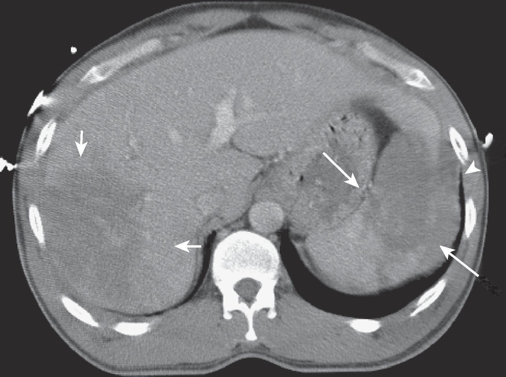 Fig. 63.2, Complex splenic laceration.