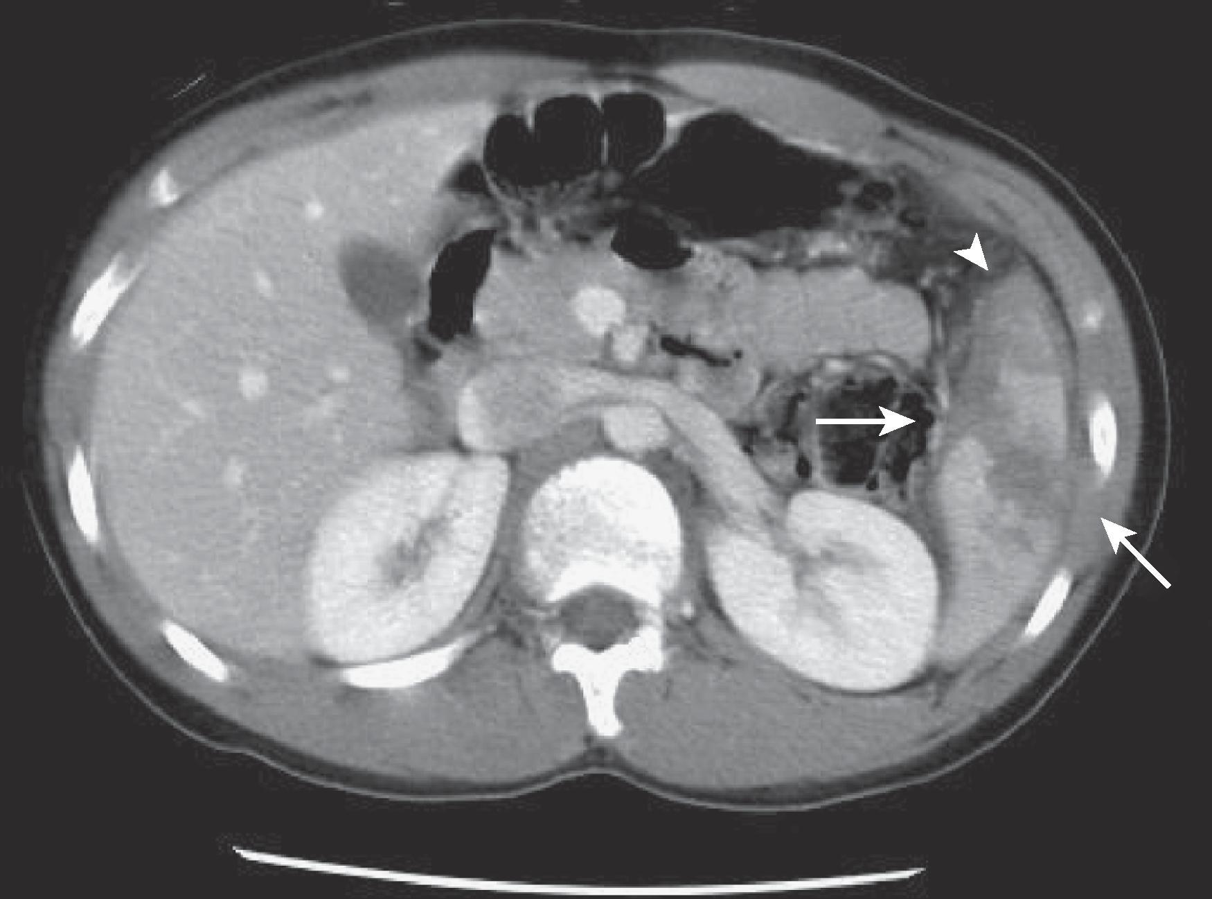 Fig. 63.3, Splenic fracture.